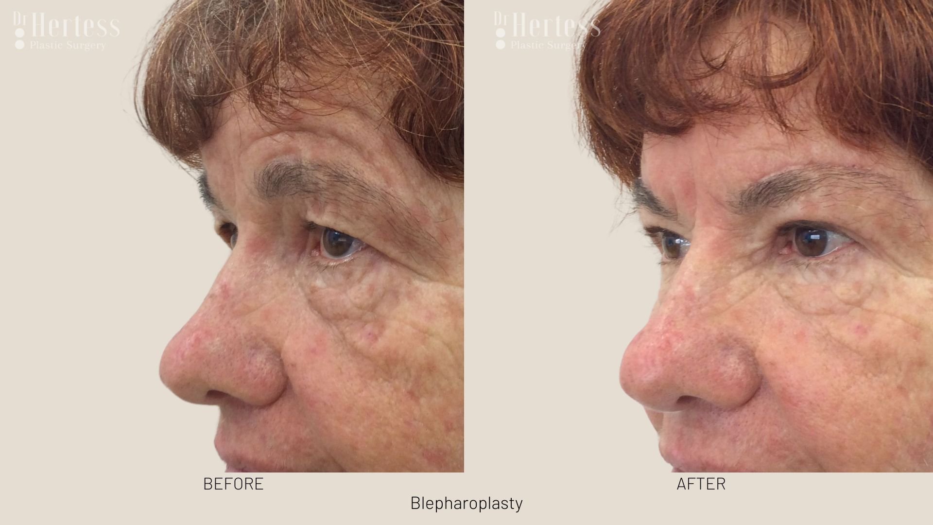 blepharoplasty surgery before and after