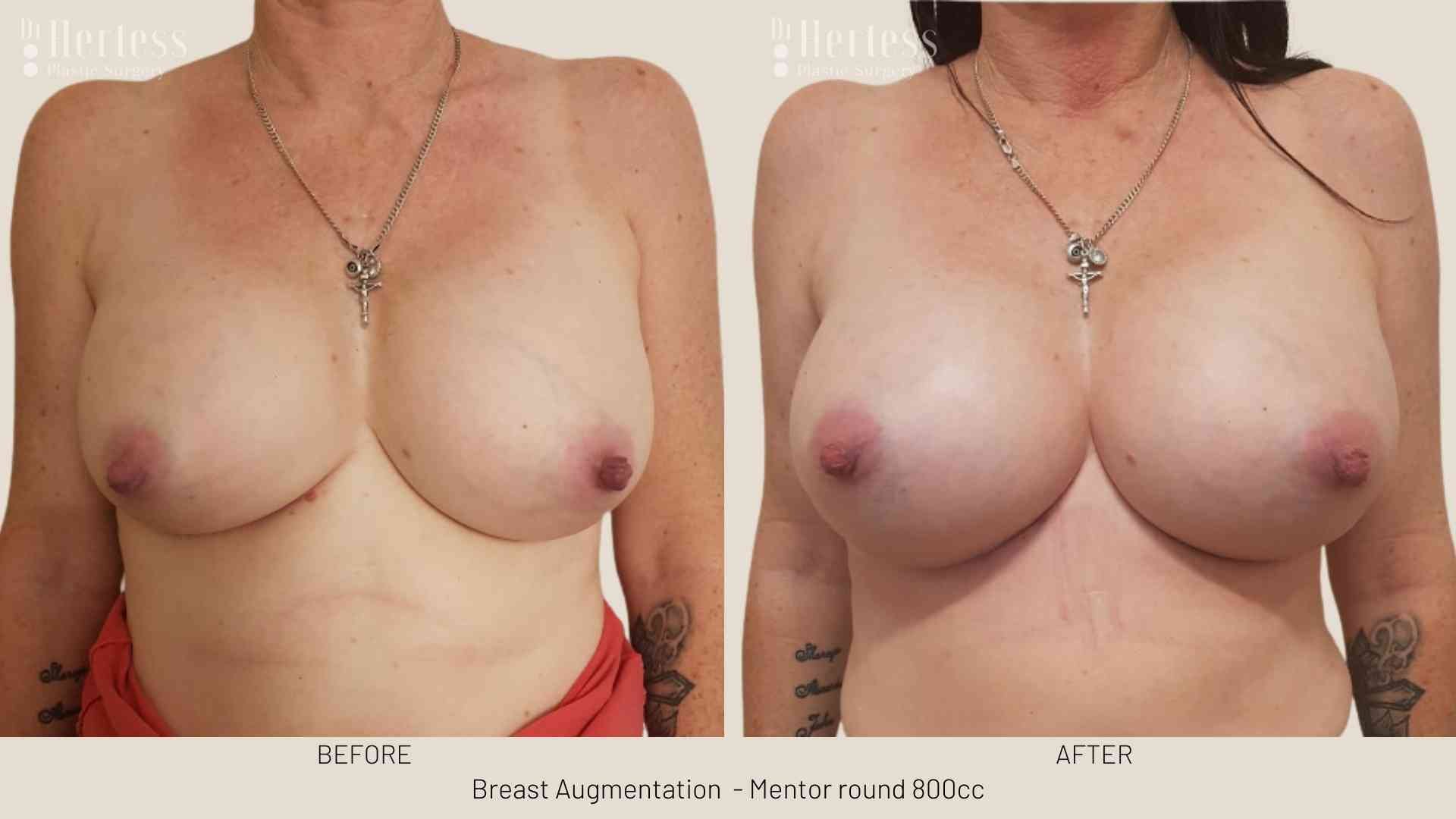 breast implants before and after photos