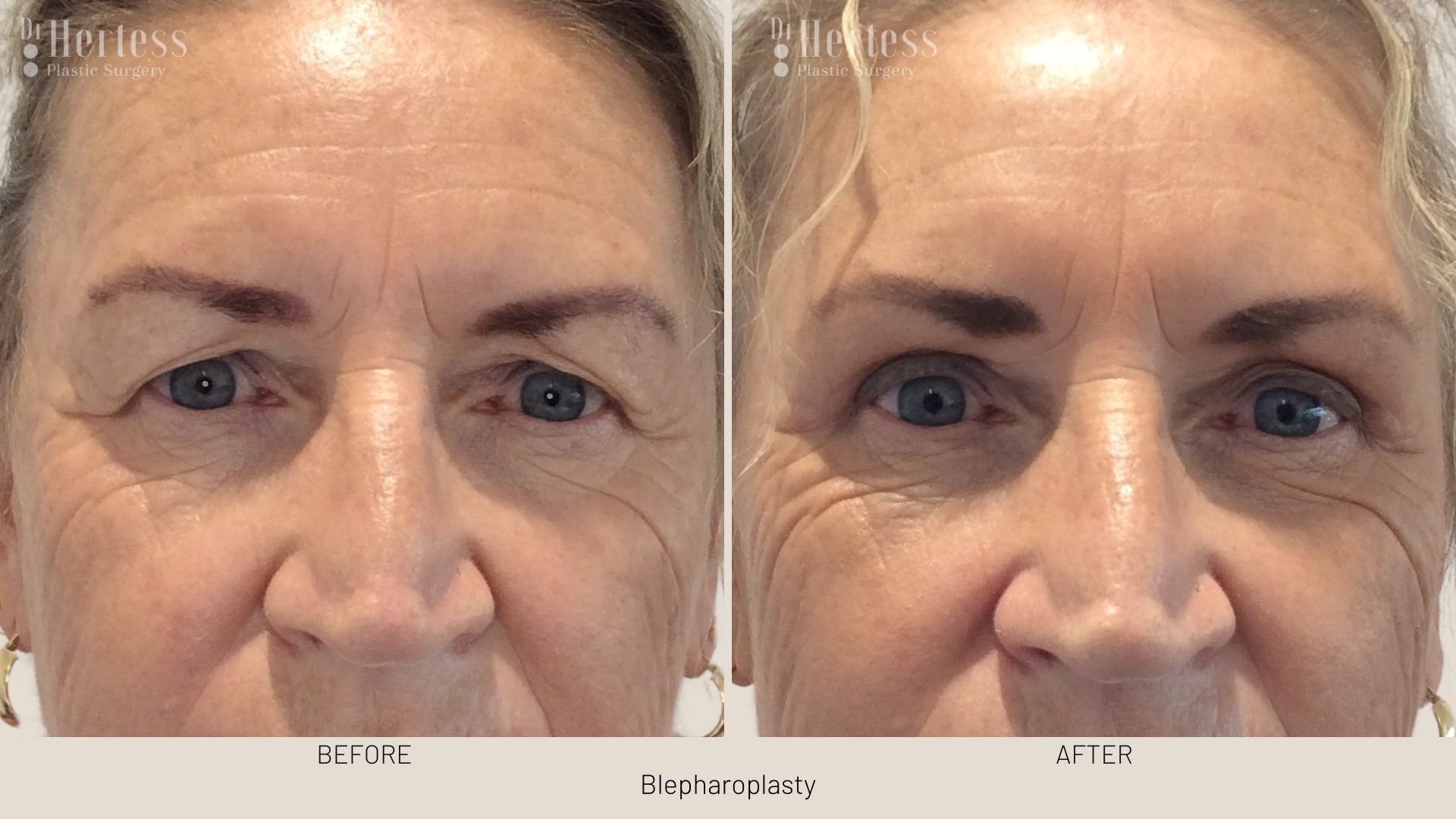 blepharoplasty surgery before and after