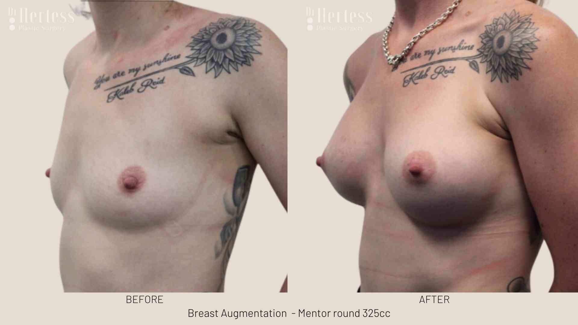 breast implants before and after photos