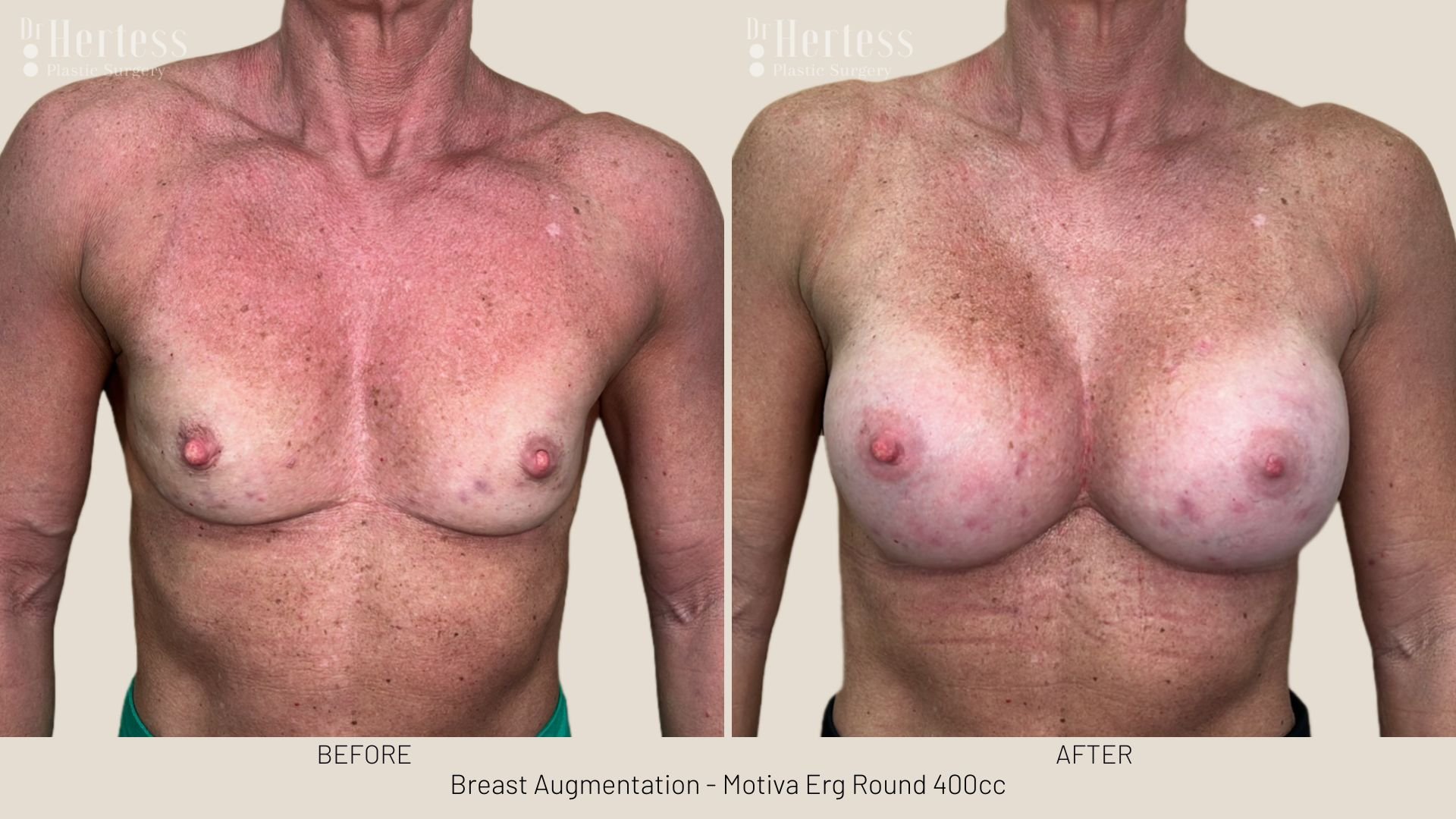 boob job before and after