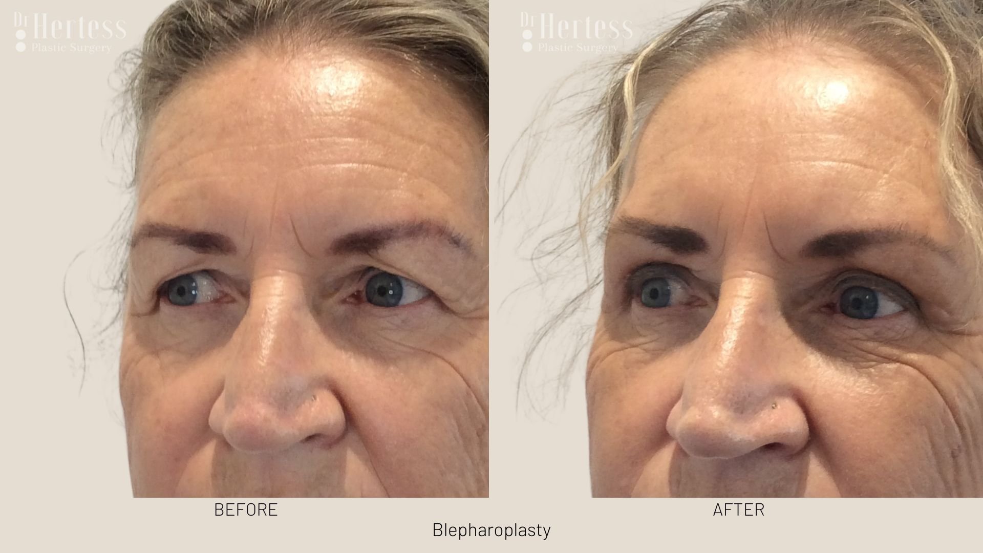 blepharoplasty surgery before and after