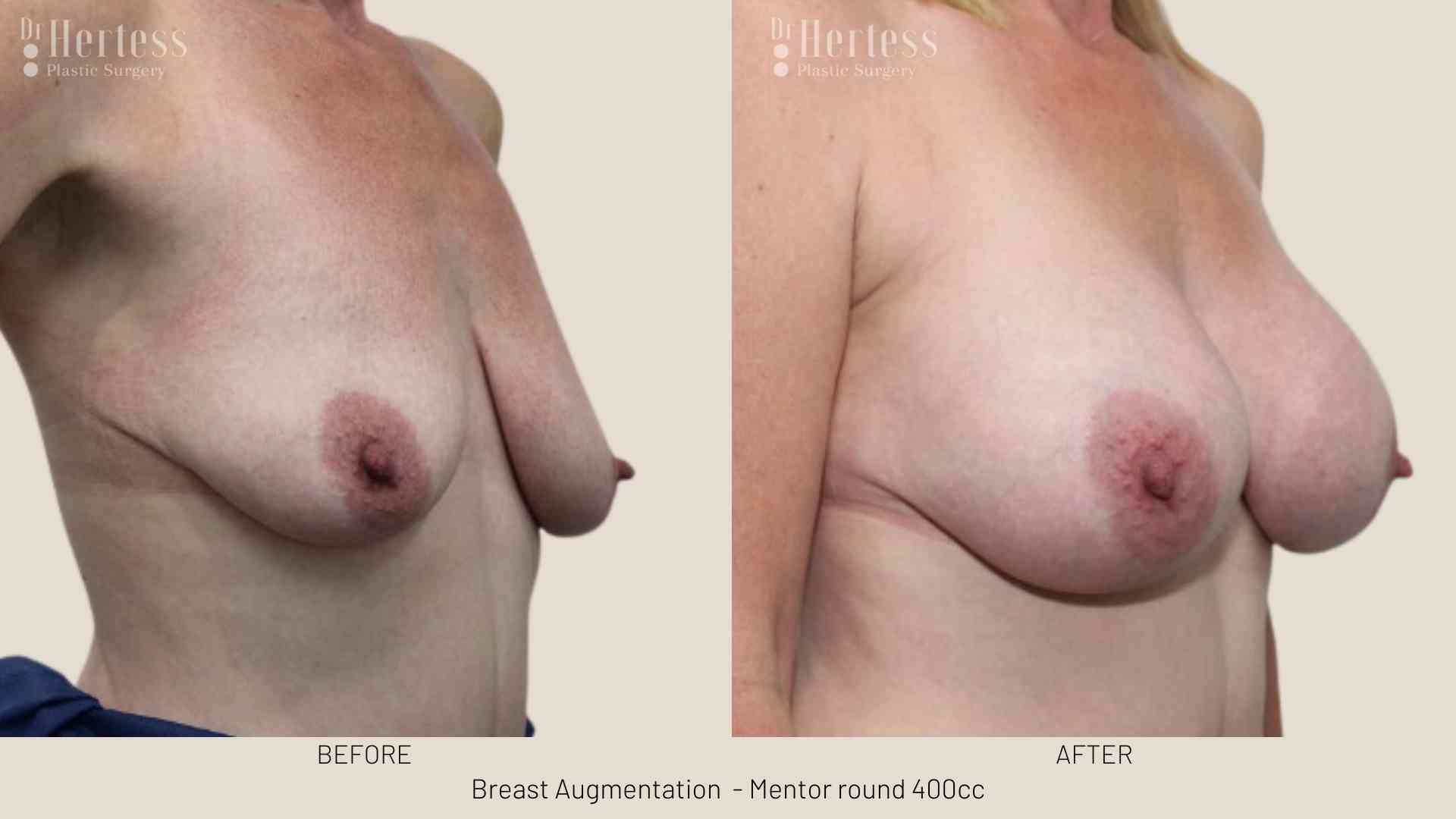 breast implants before and after photos