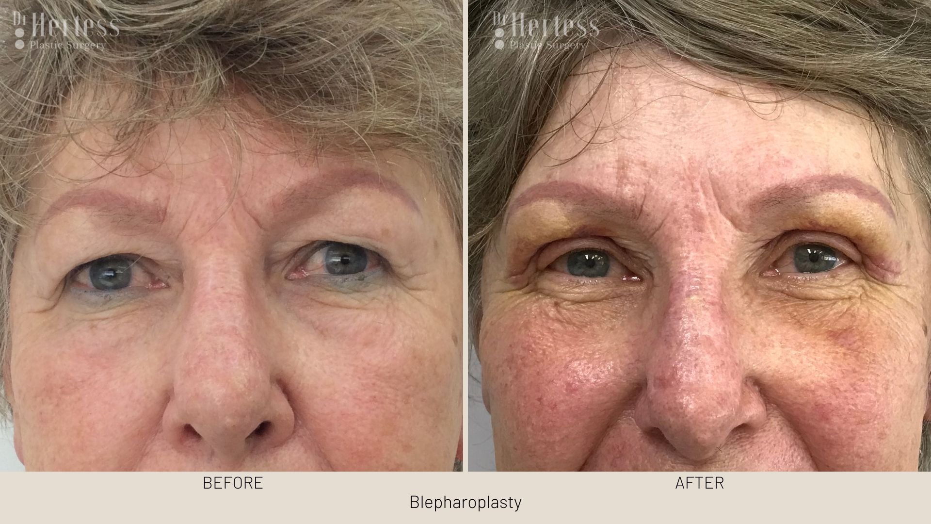 before after blepharoplasty