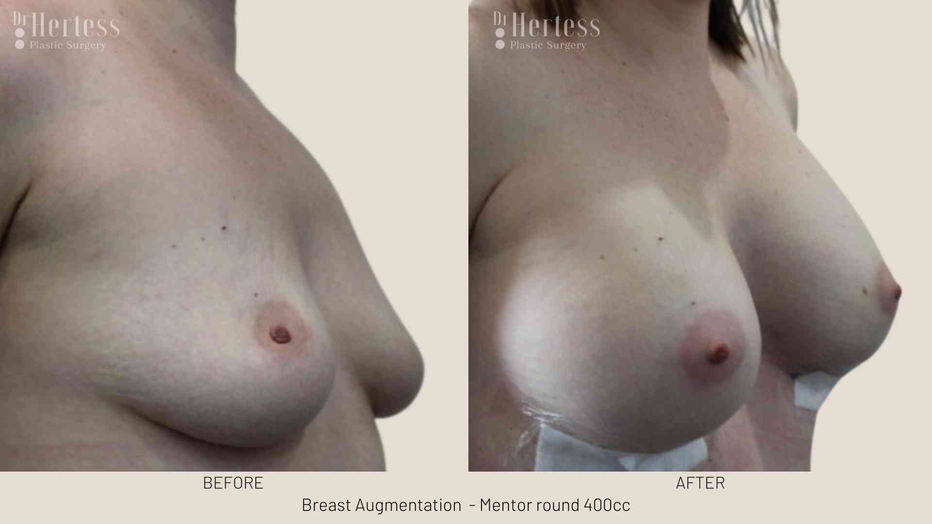 breast implants before and after photos