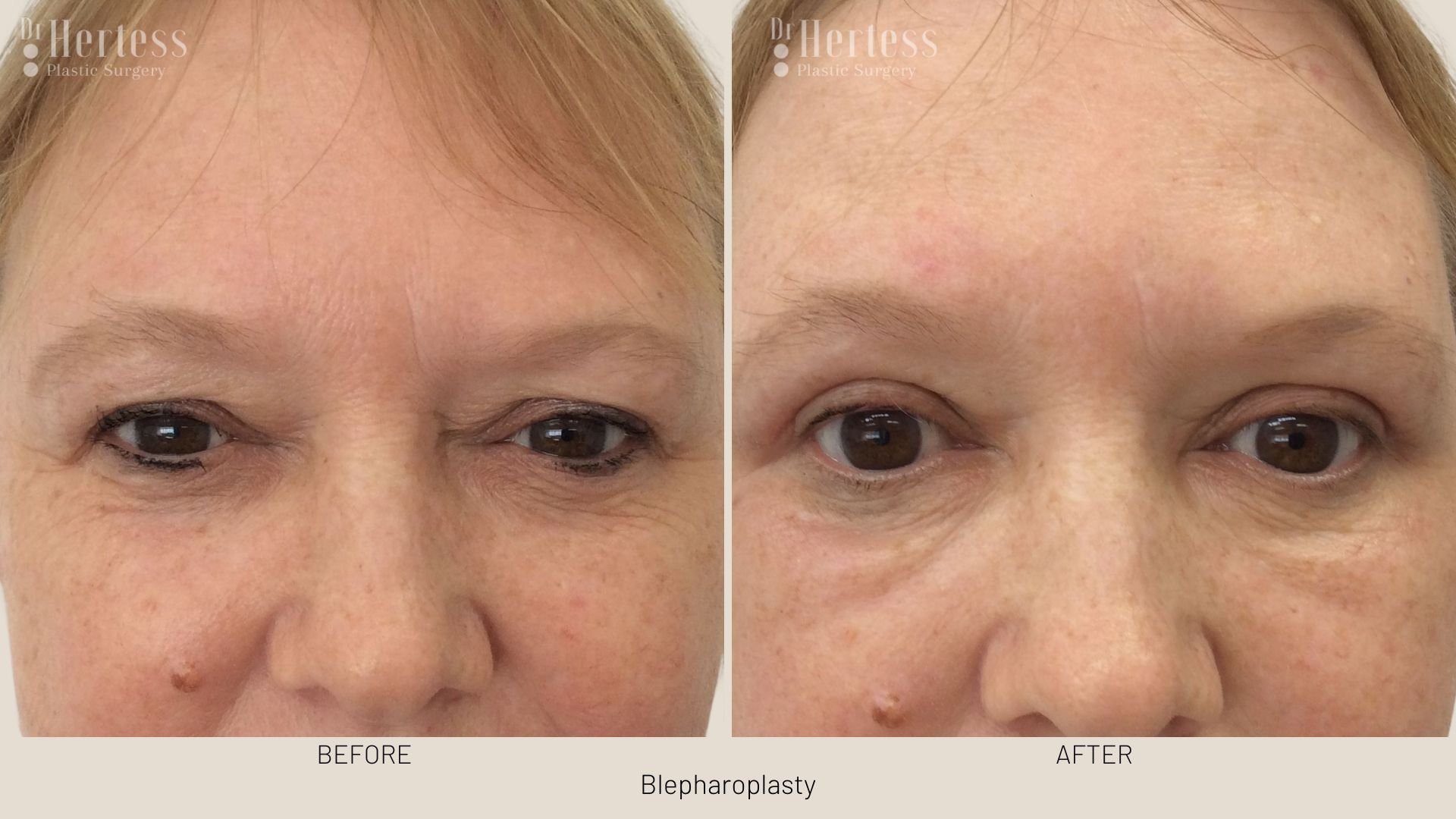 before after blepharoplasty