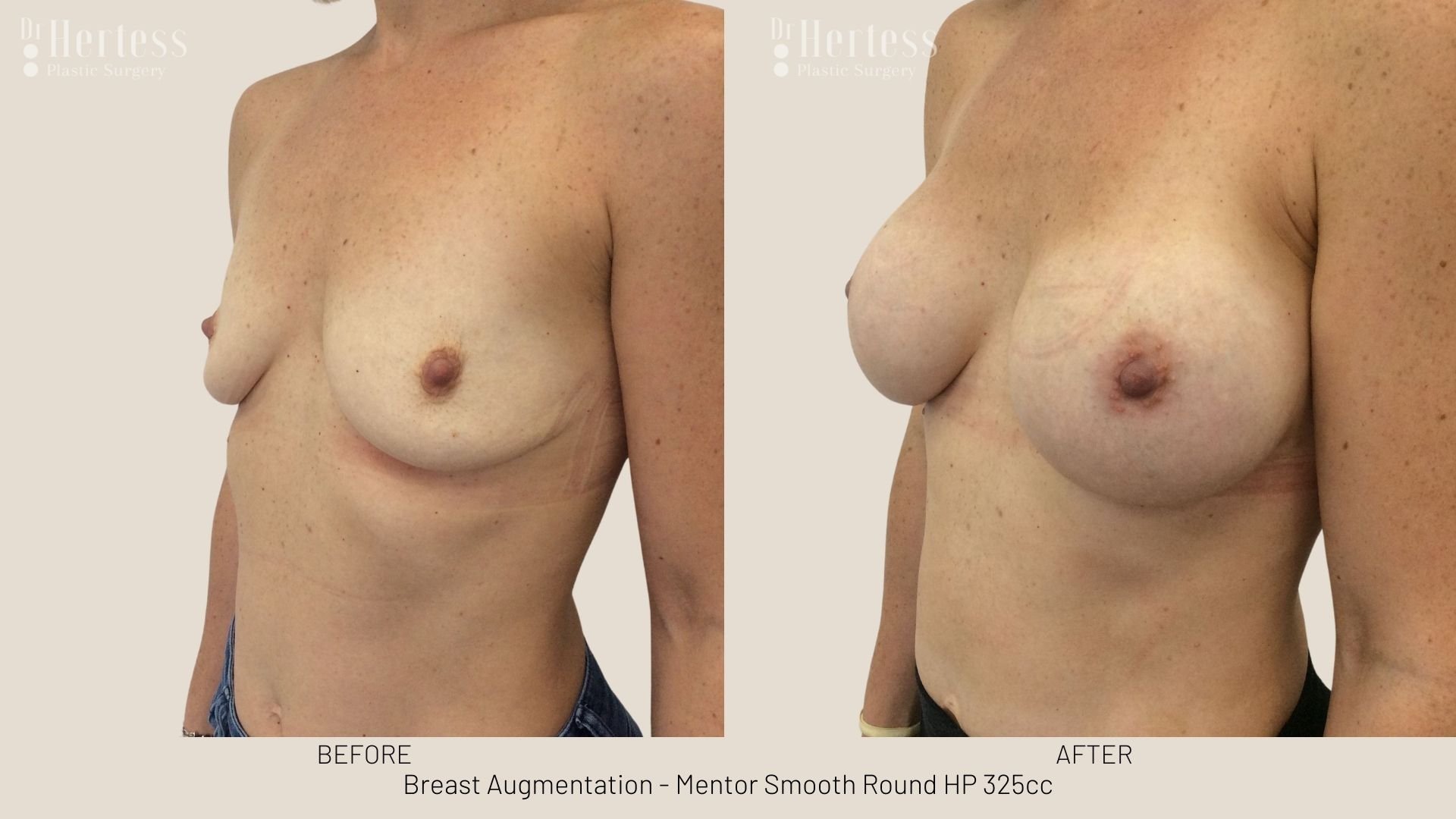 breast aug before and after