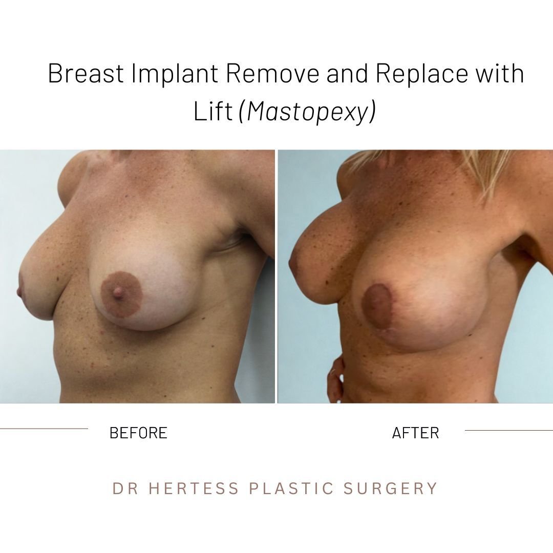 before and after breasts