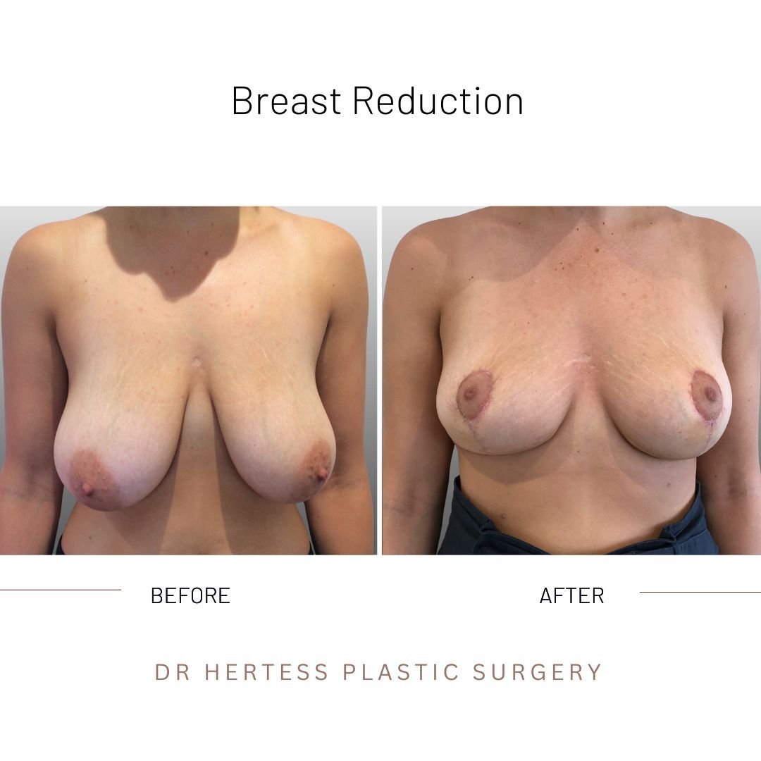 before and after breast reduction