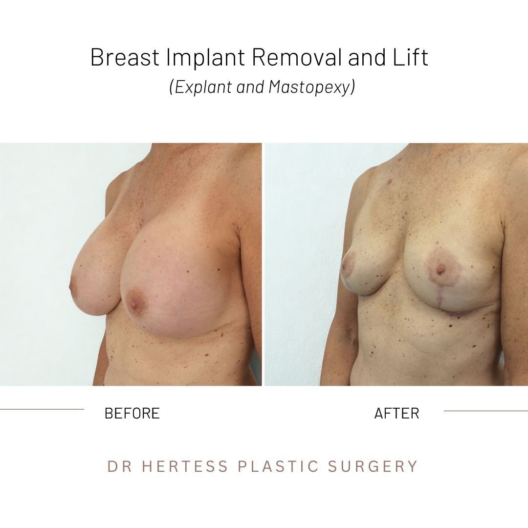 removal and lift before after