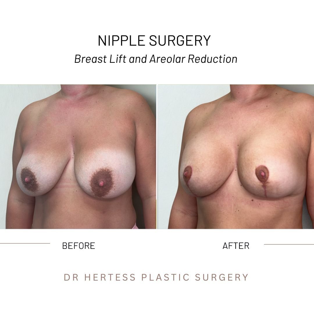 before and after nipple surgery
