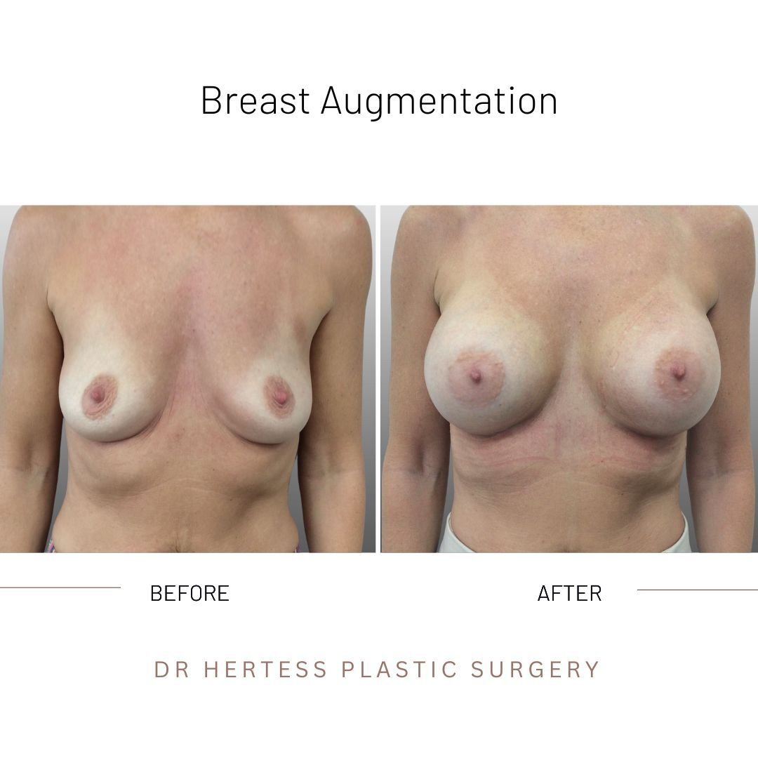 boob job before and after