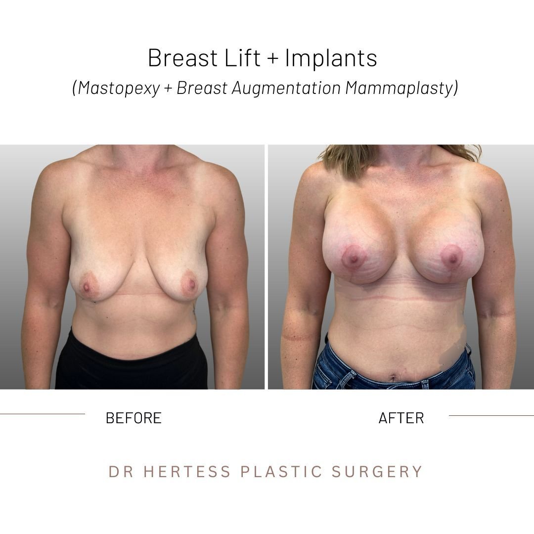 breast lift before and after