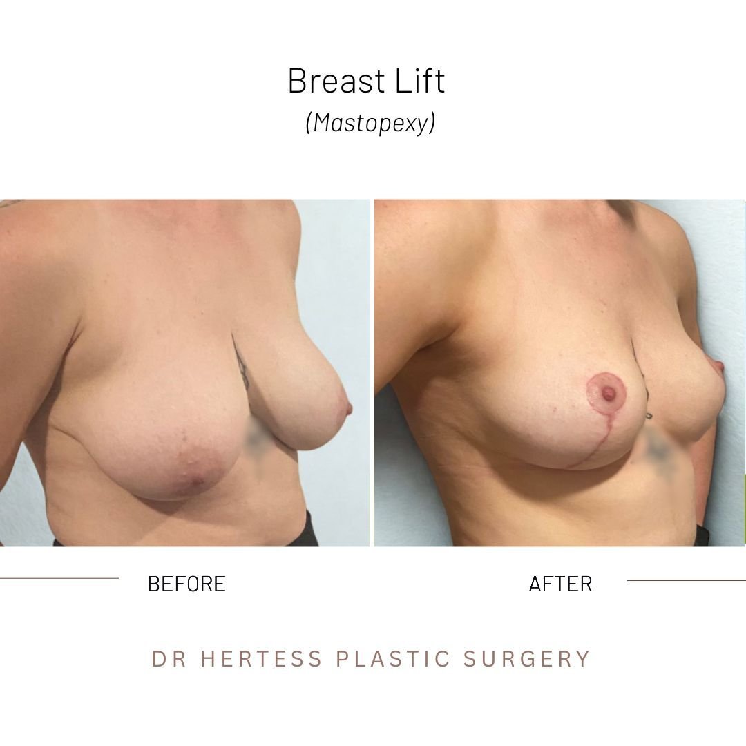 breast lift before and after