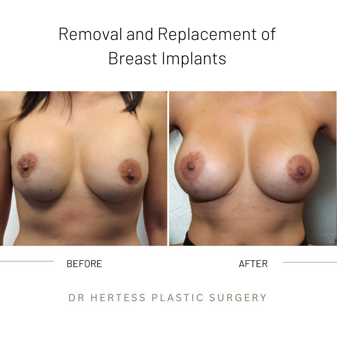 breast implant remove replace before and after