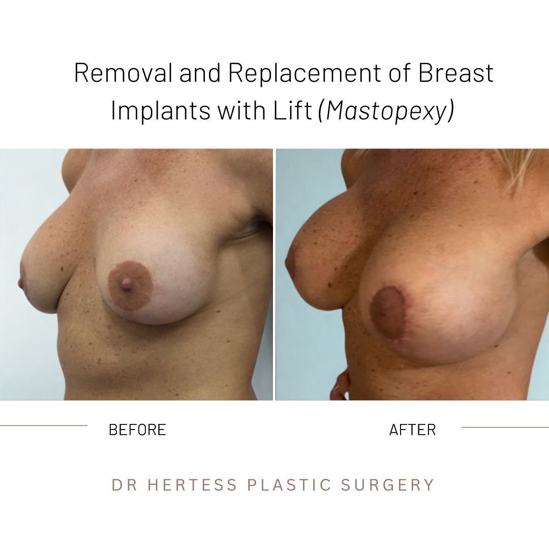 breast remove and replace before and after