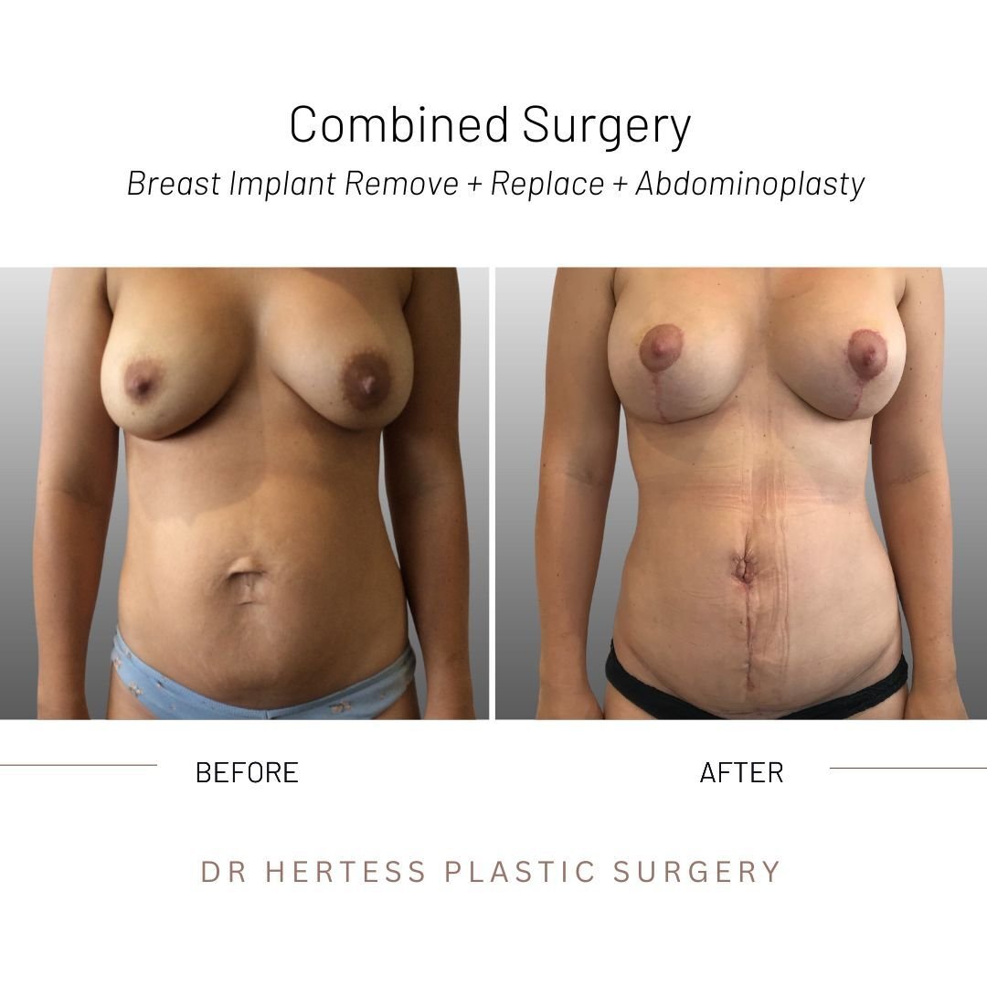 Mummy makeover before after