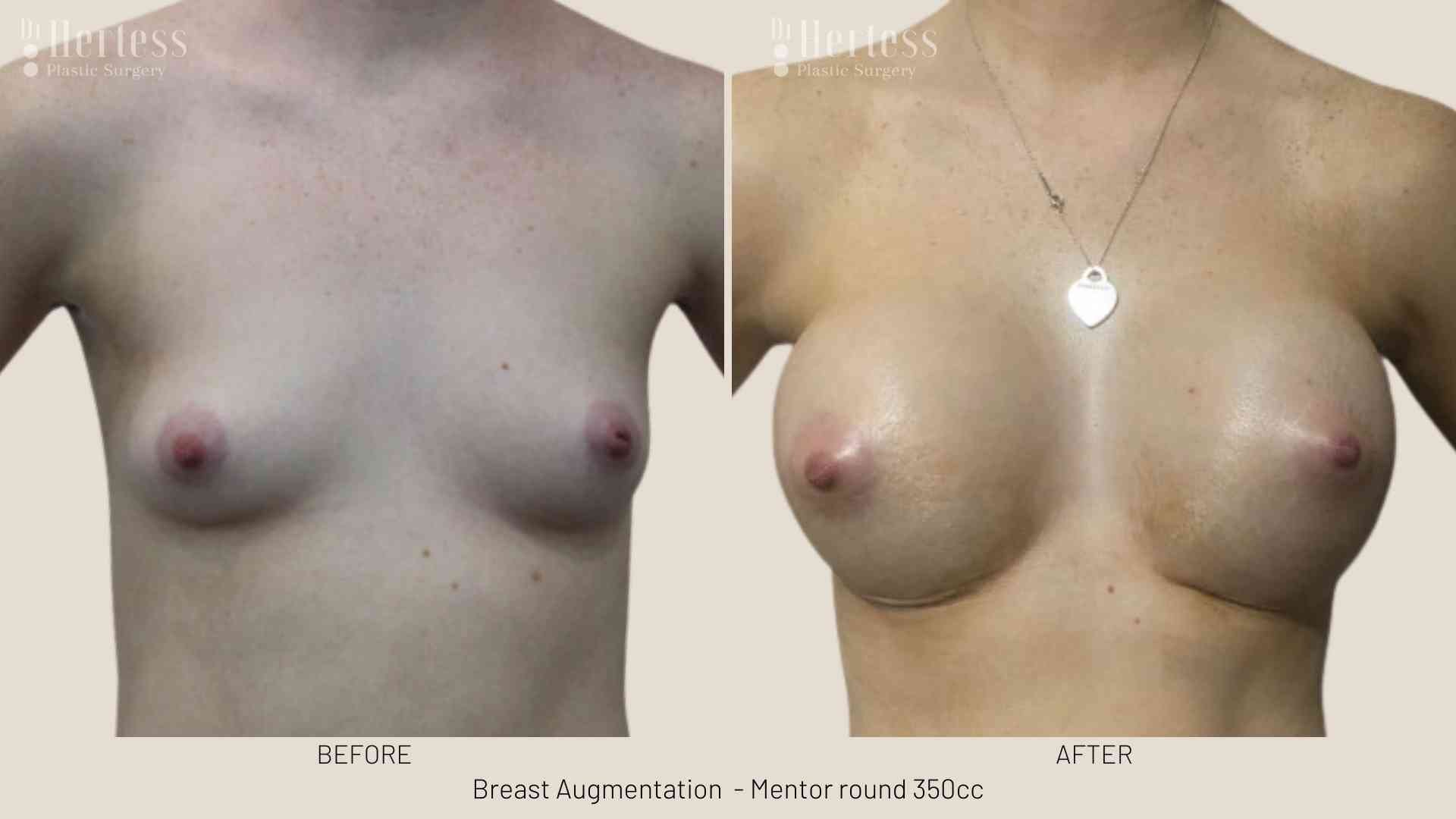 breast implants before and after pics