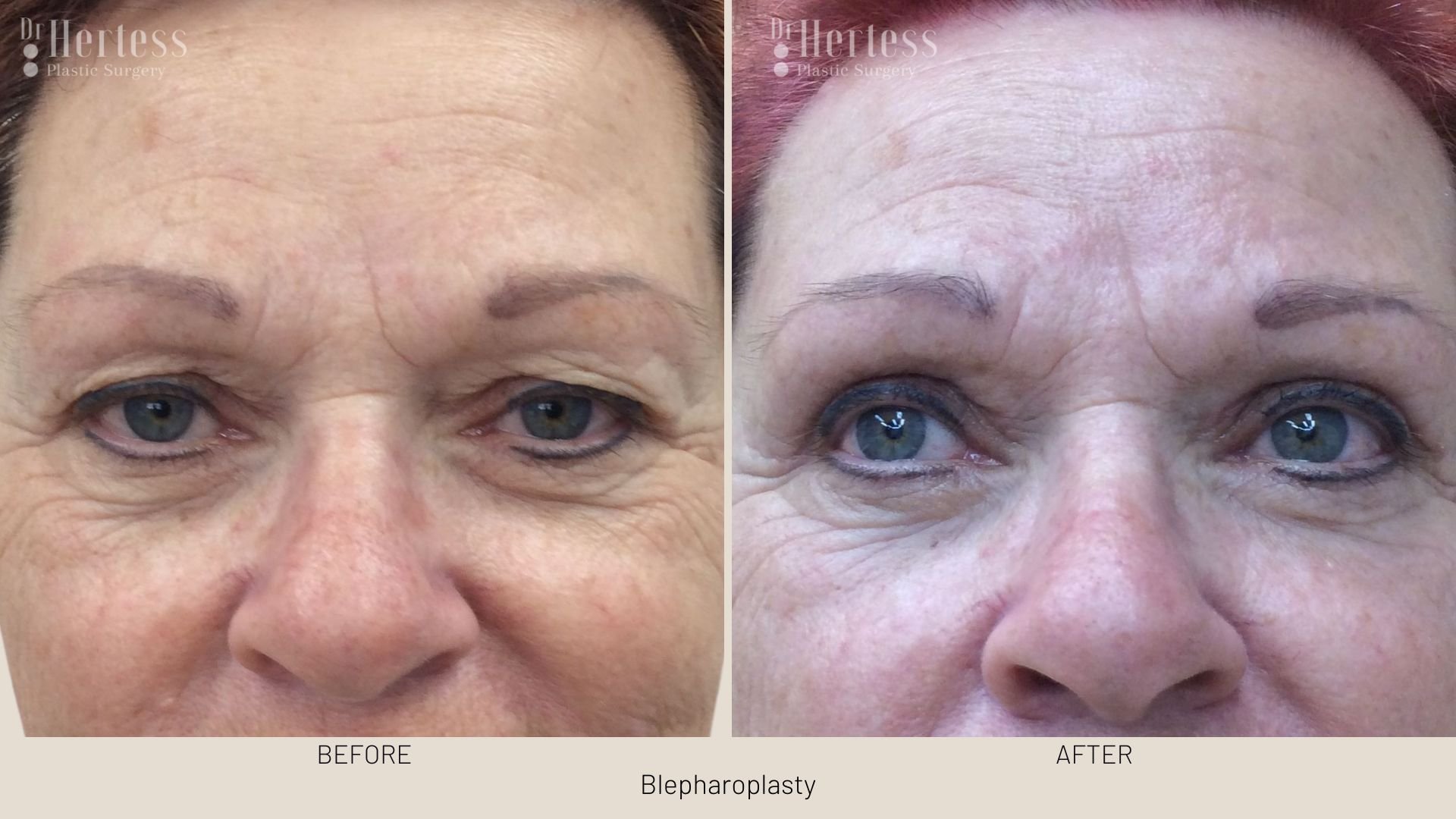 before after blepharoplasty