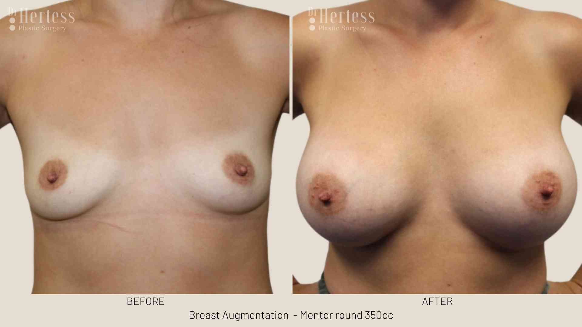 breast implants before and after pics
