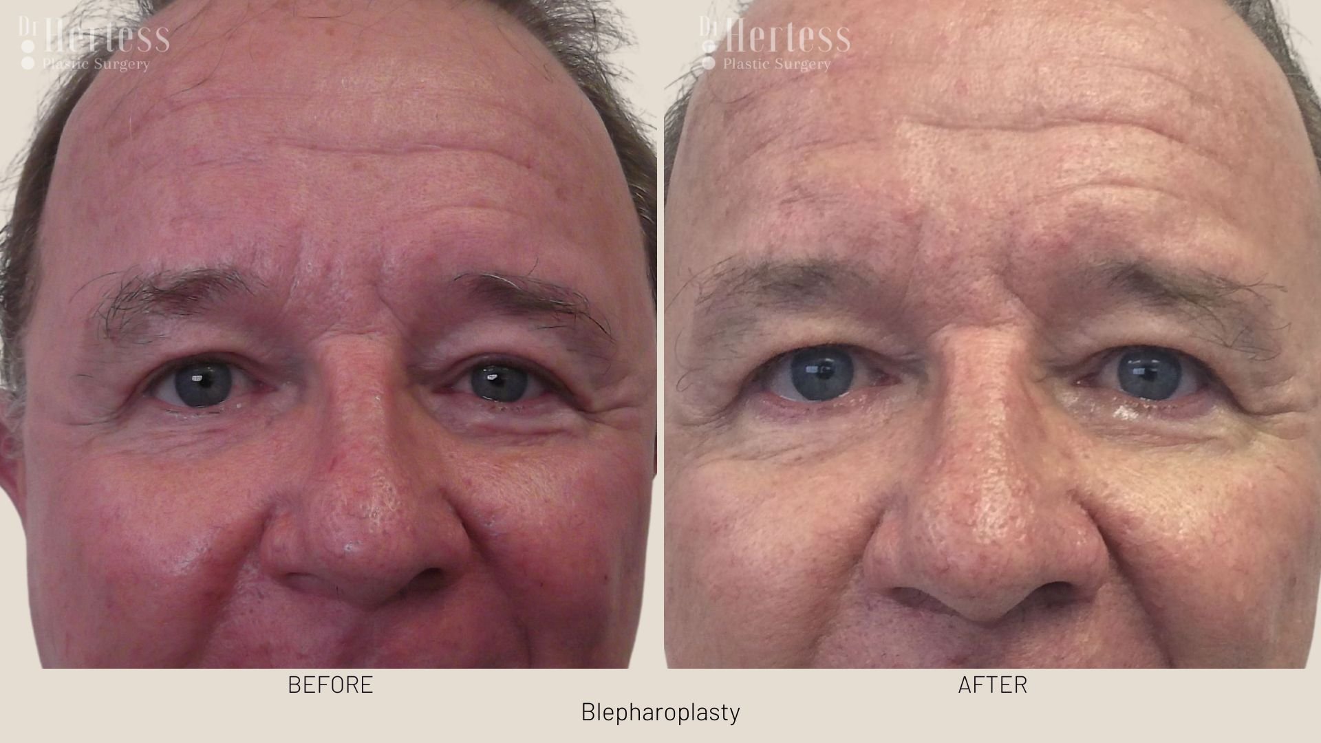 before after blepharoplasty