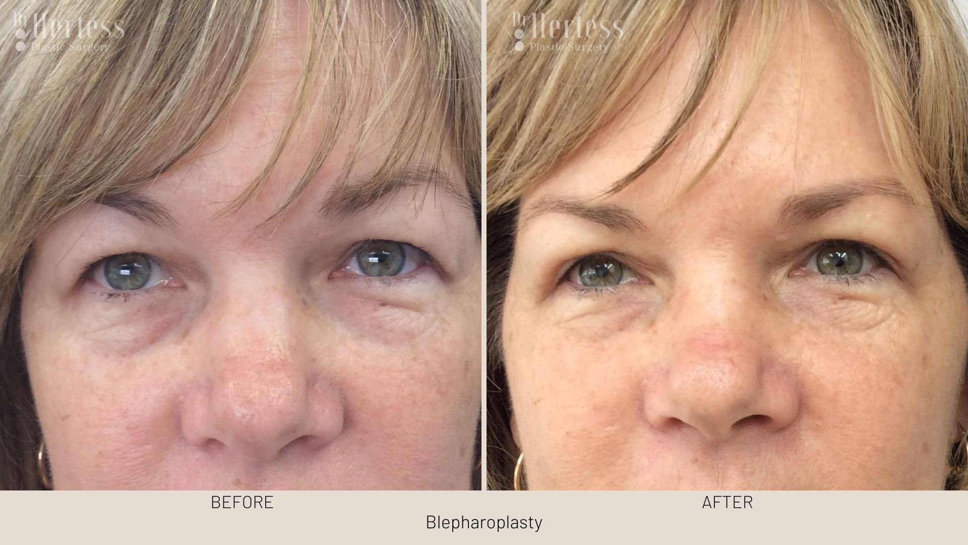 before after blepharoplasty