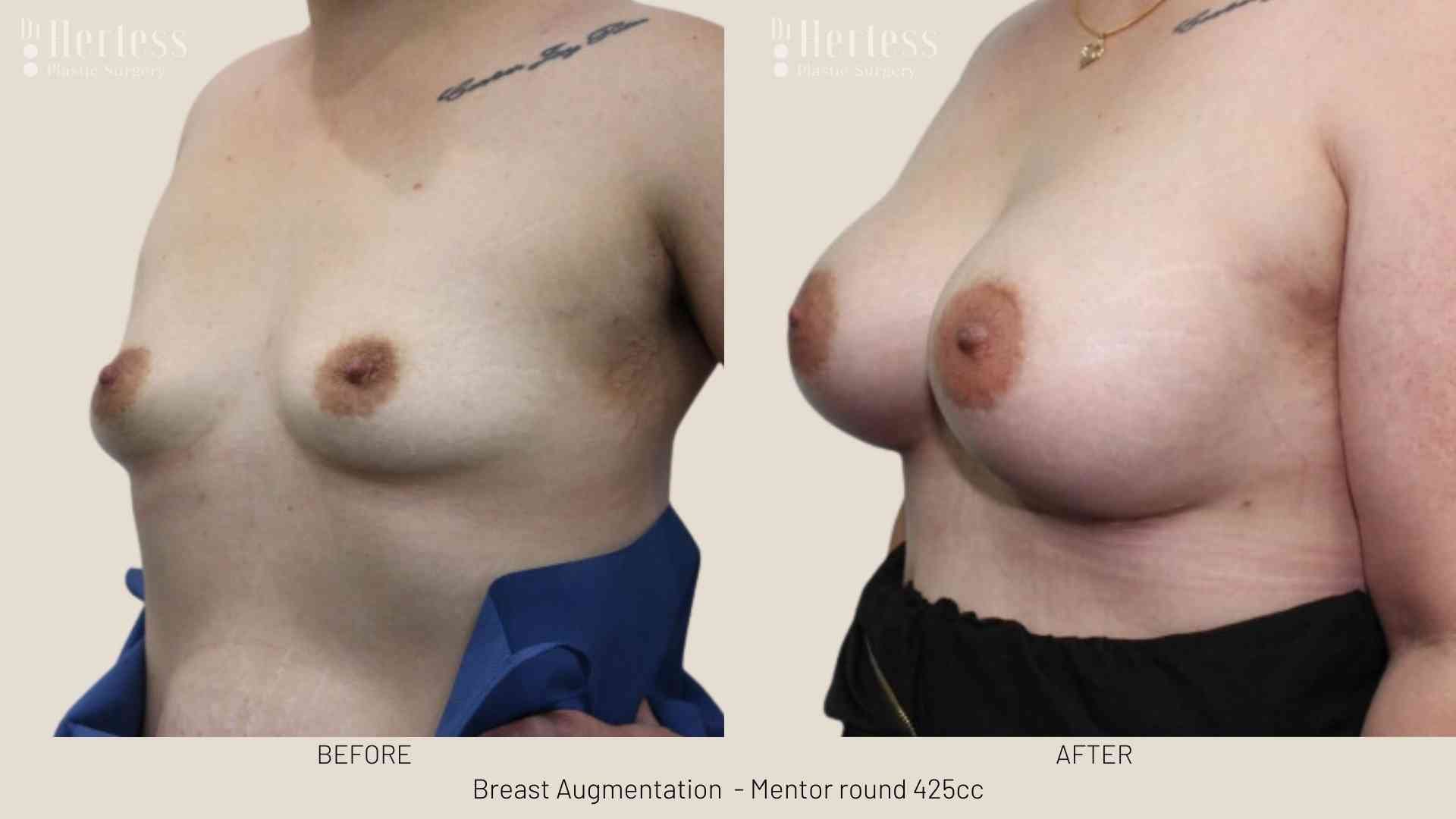 breast implants before and after pics