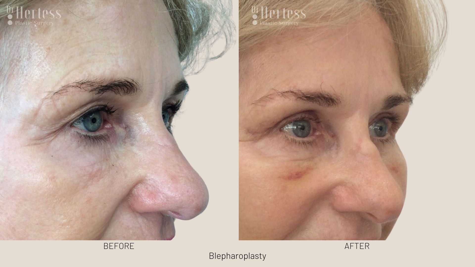 before after blepharoplasty