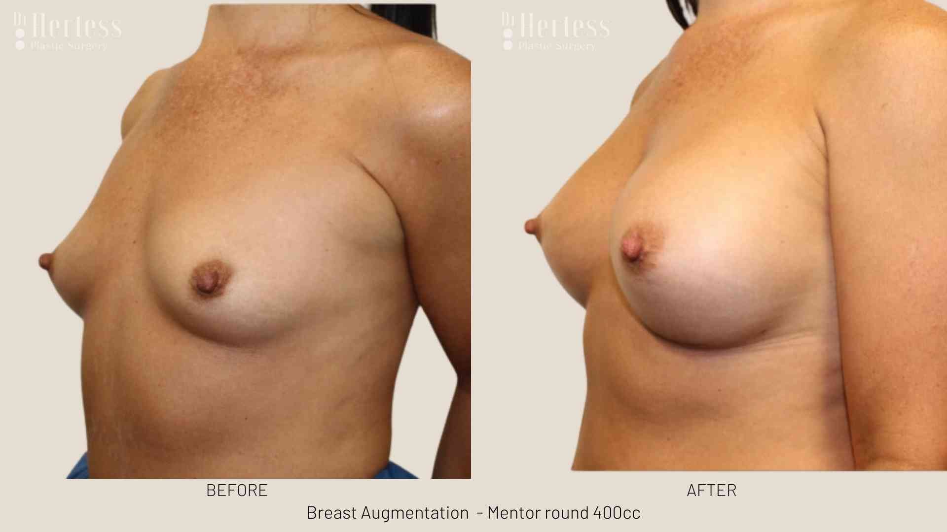 breast lift and implant before and after