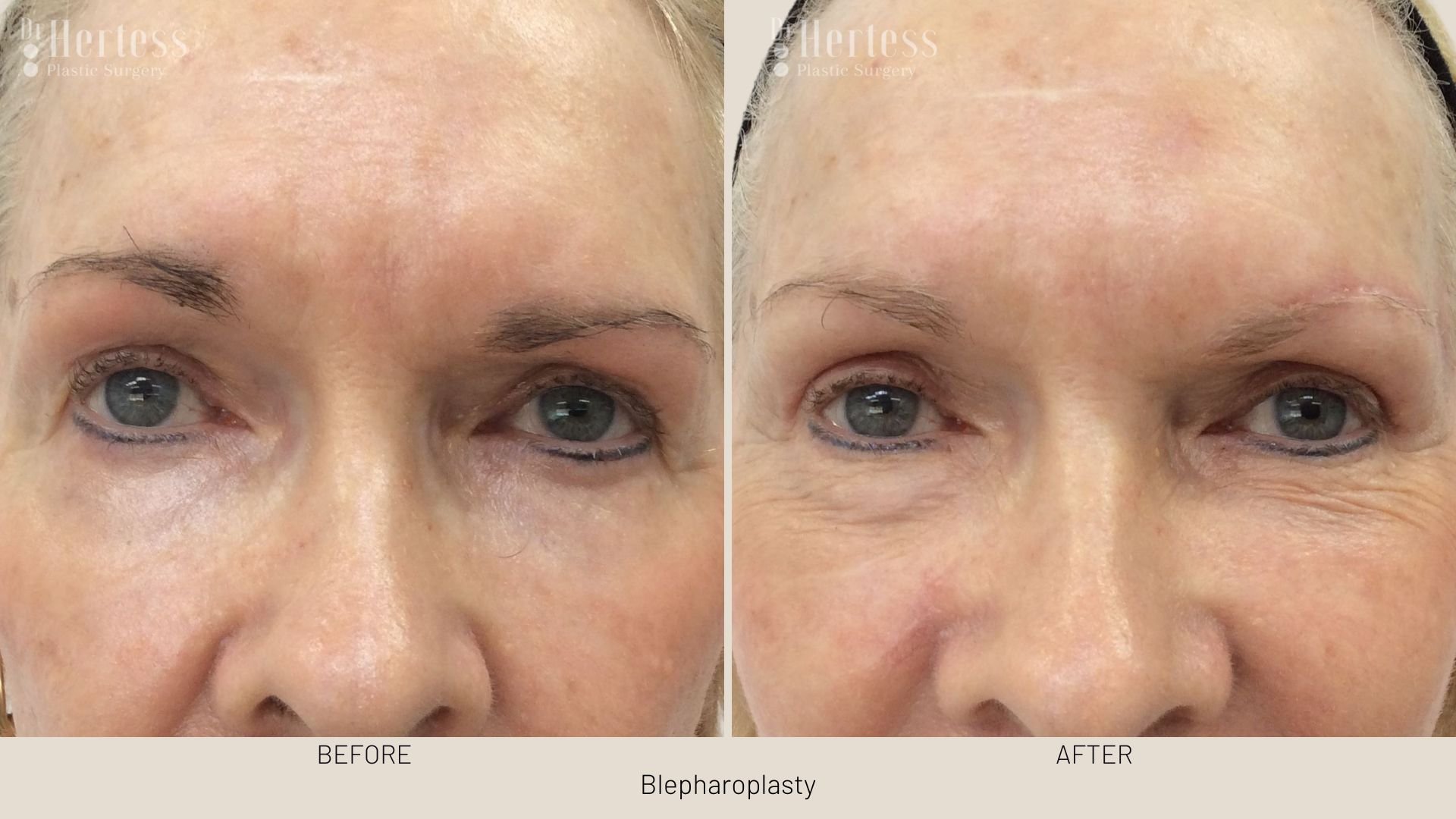 before after blepharoplasty