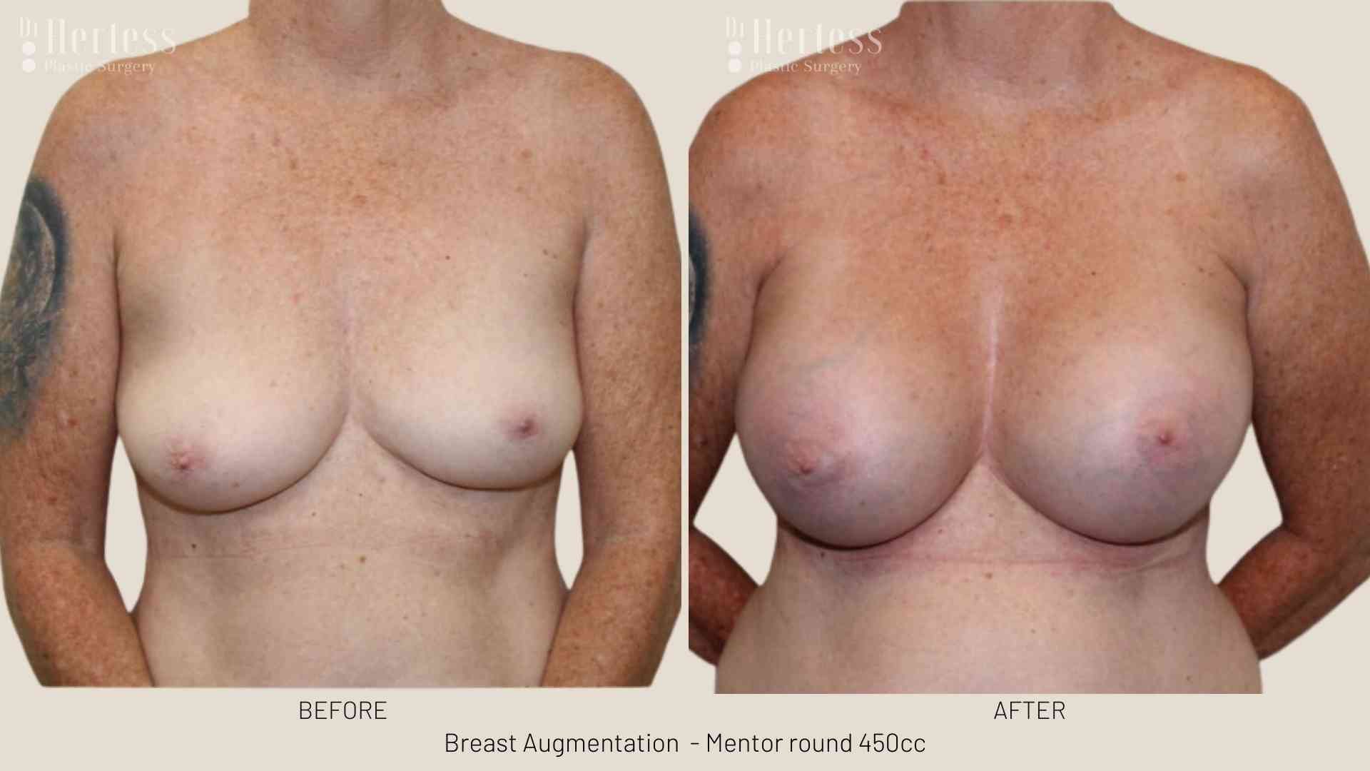breast lift and implant before and after