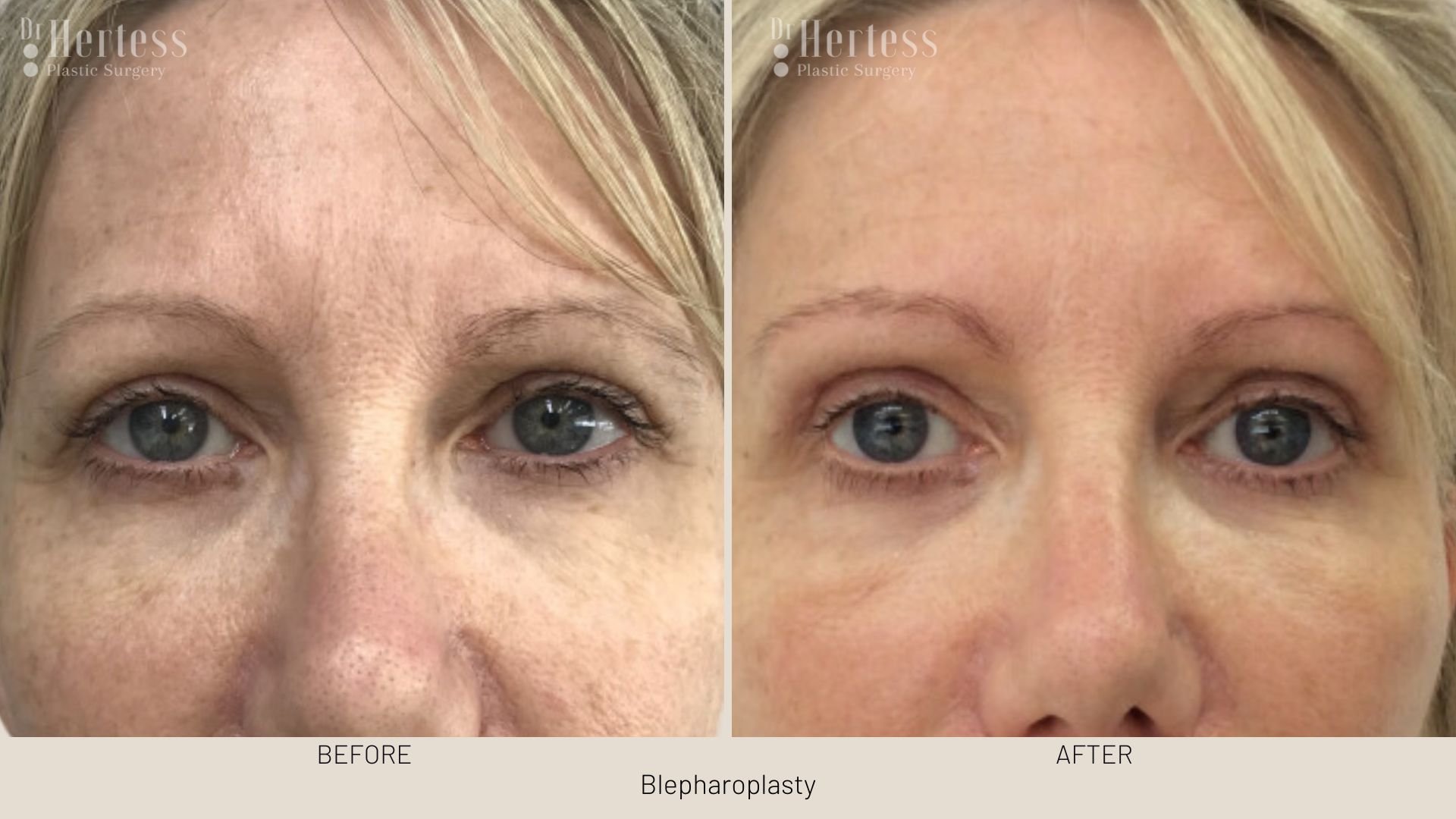 before after blepharoplasty