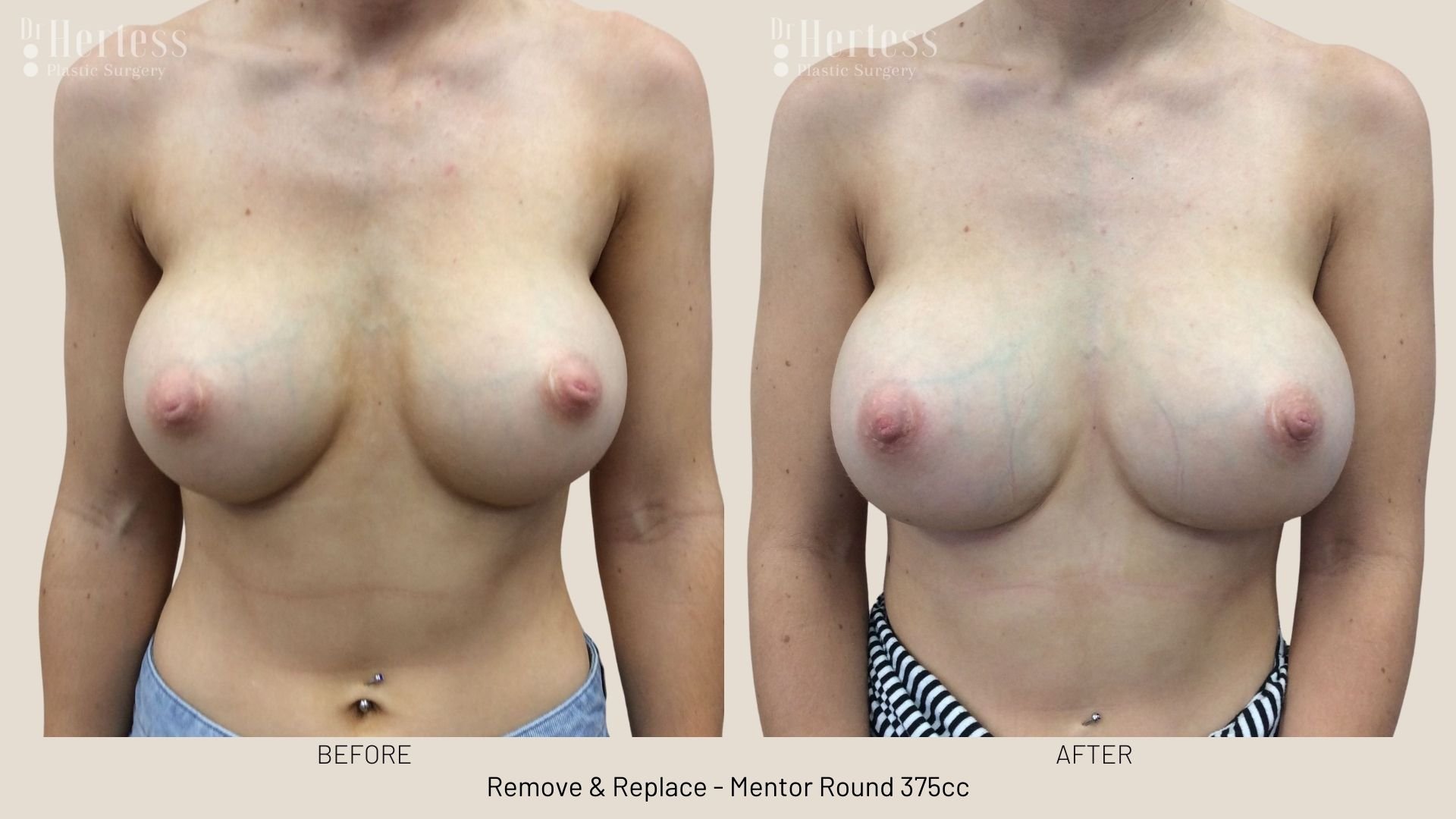 breast implant removal and replacement