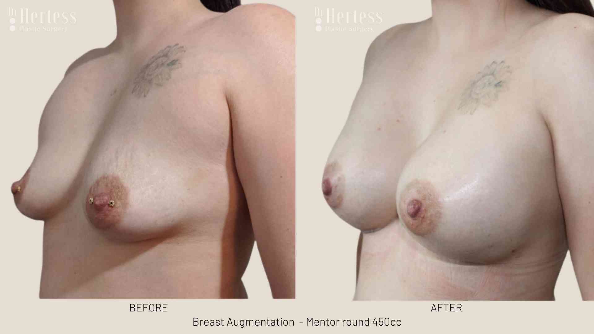 breast lift and implant before and after