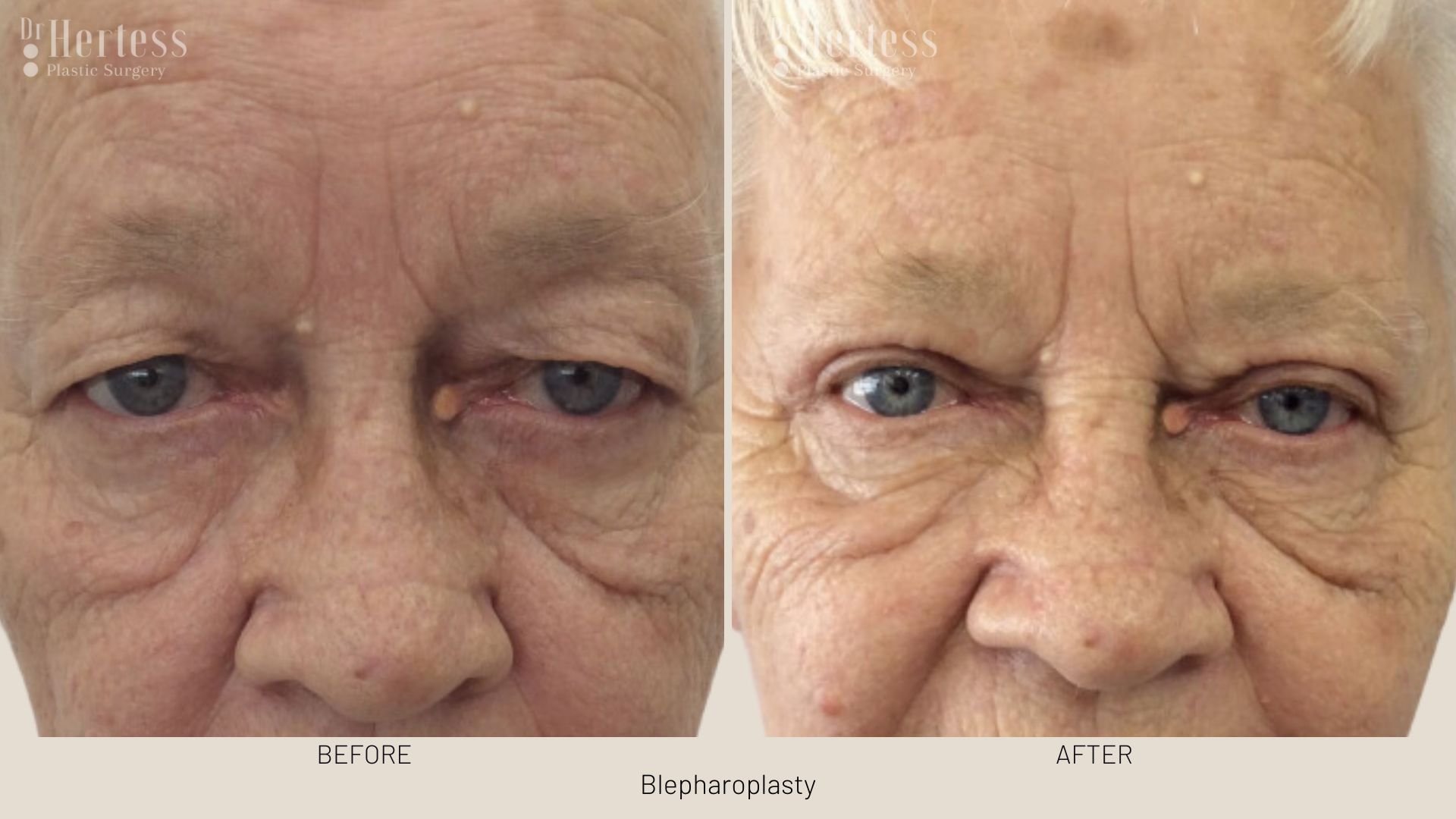 before after blepharoplasty