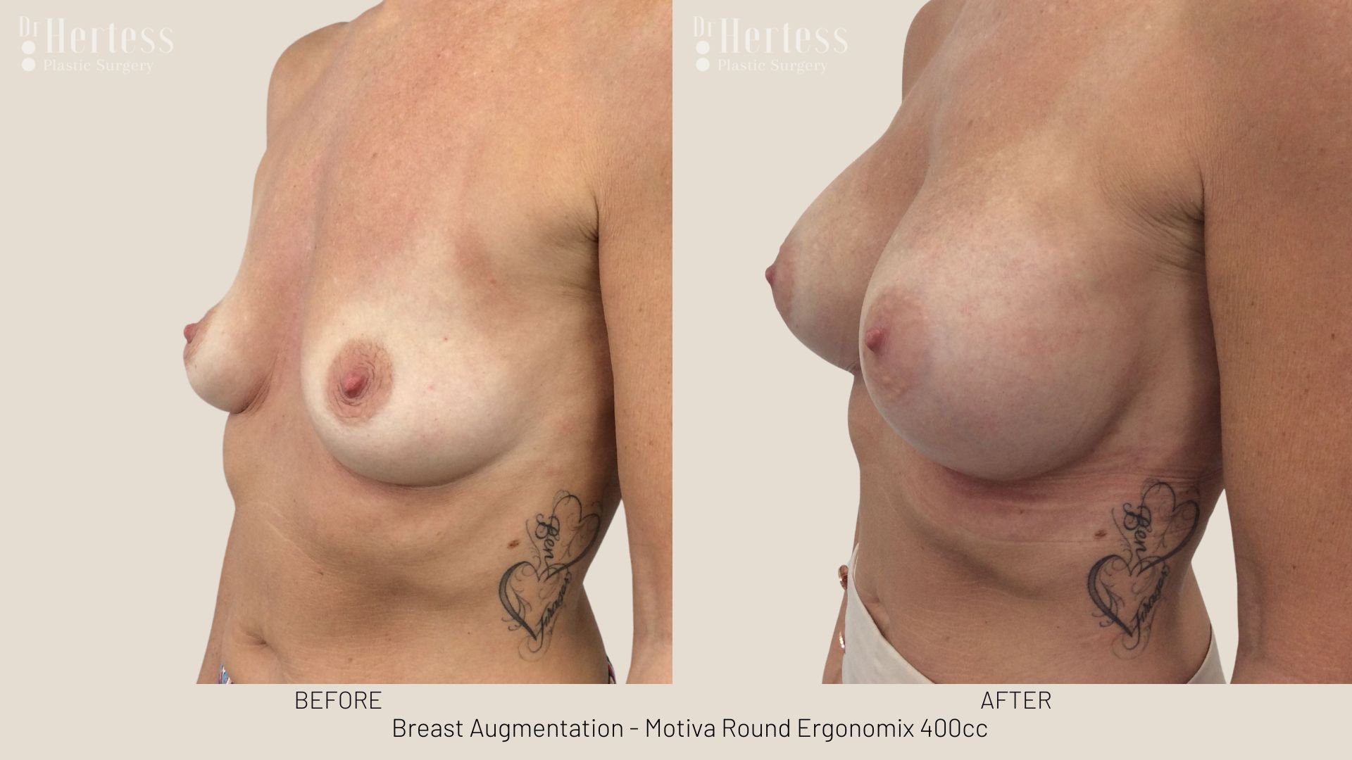 breast implant photos