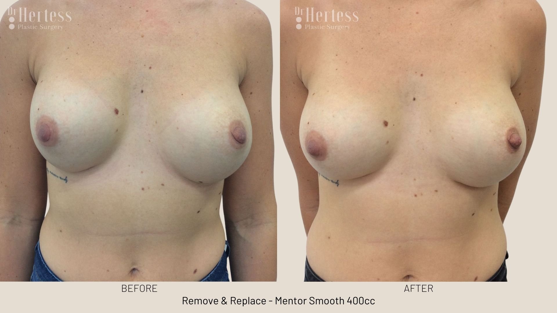 breast implant removal and replacement