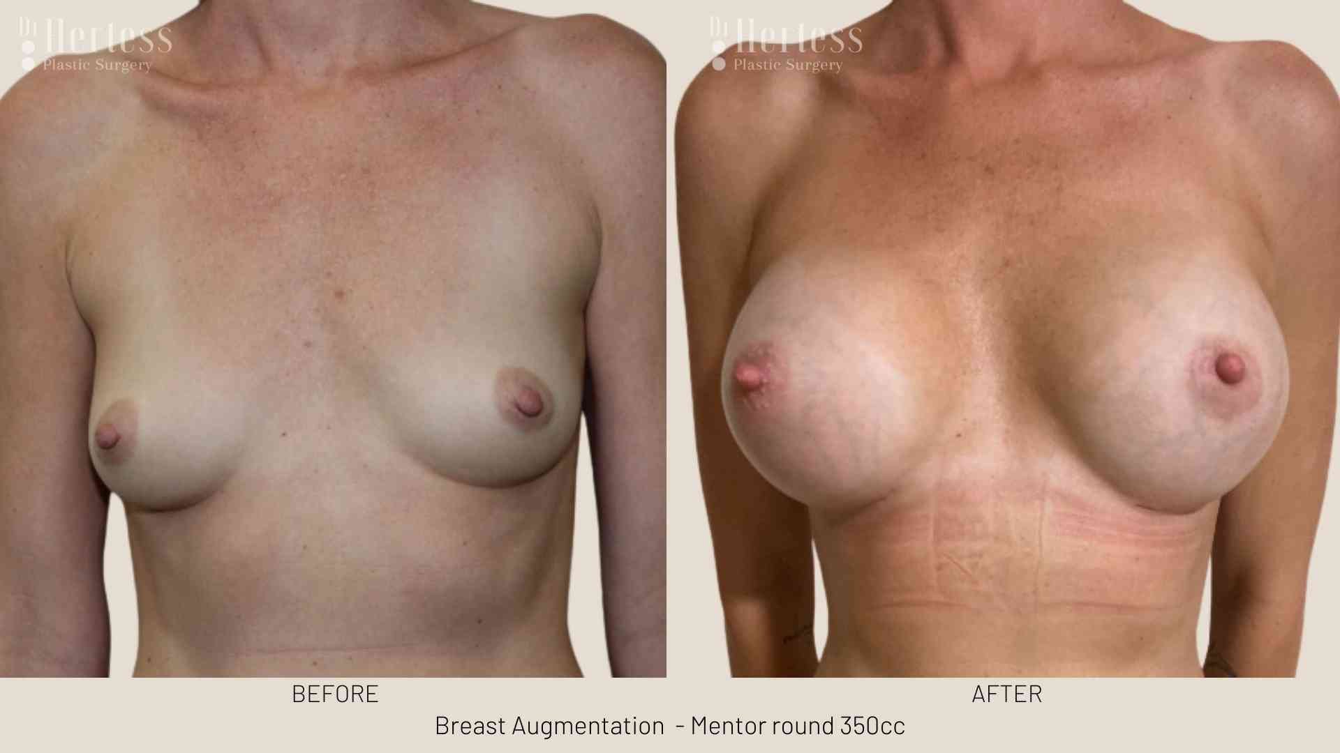 breast lift and implant before and after