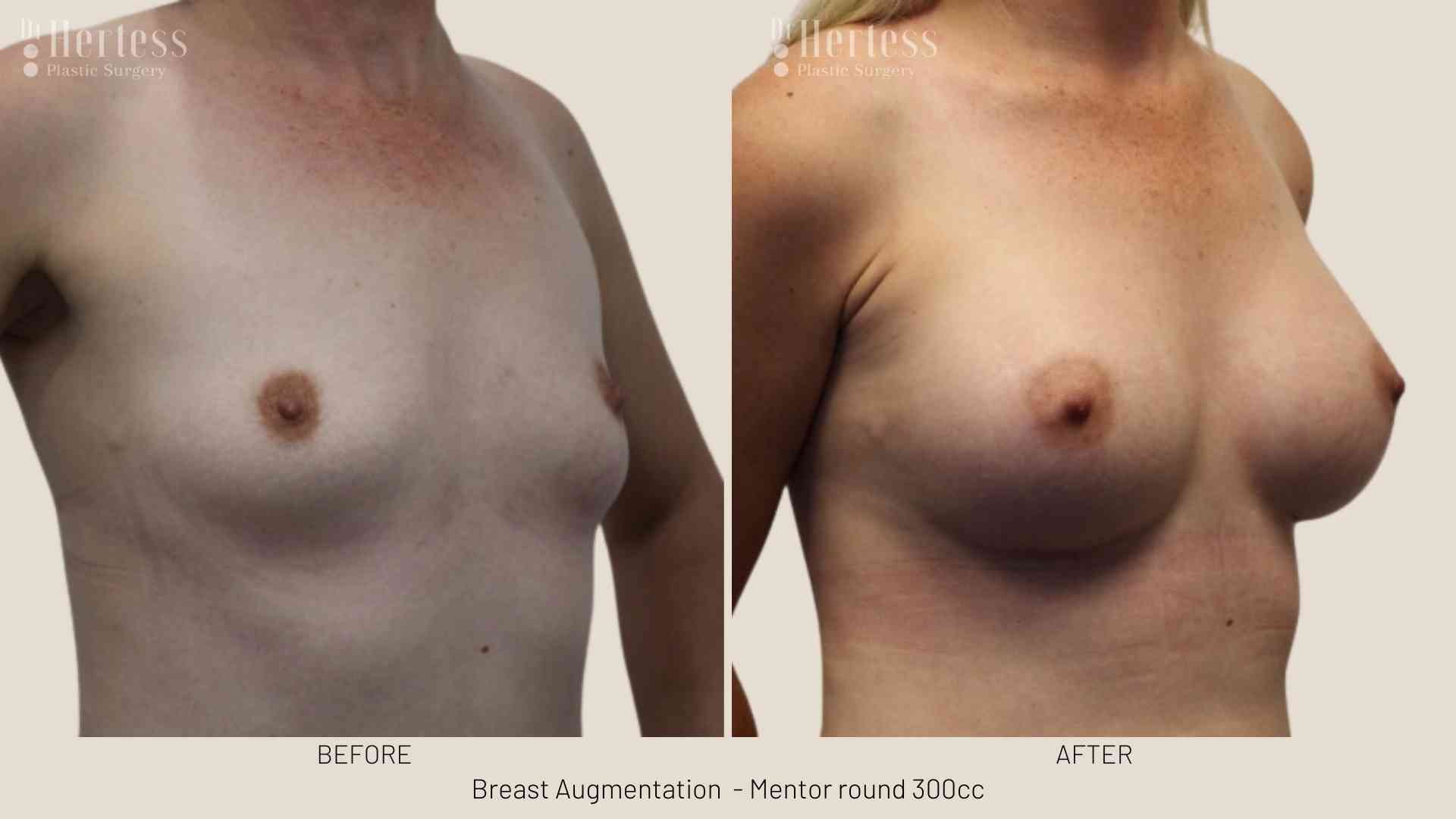 breast lift and implant before and after
