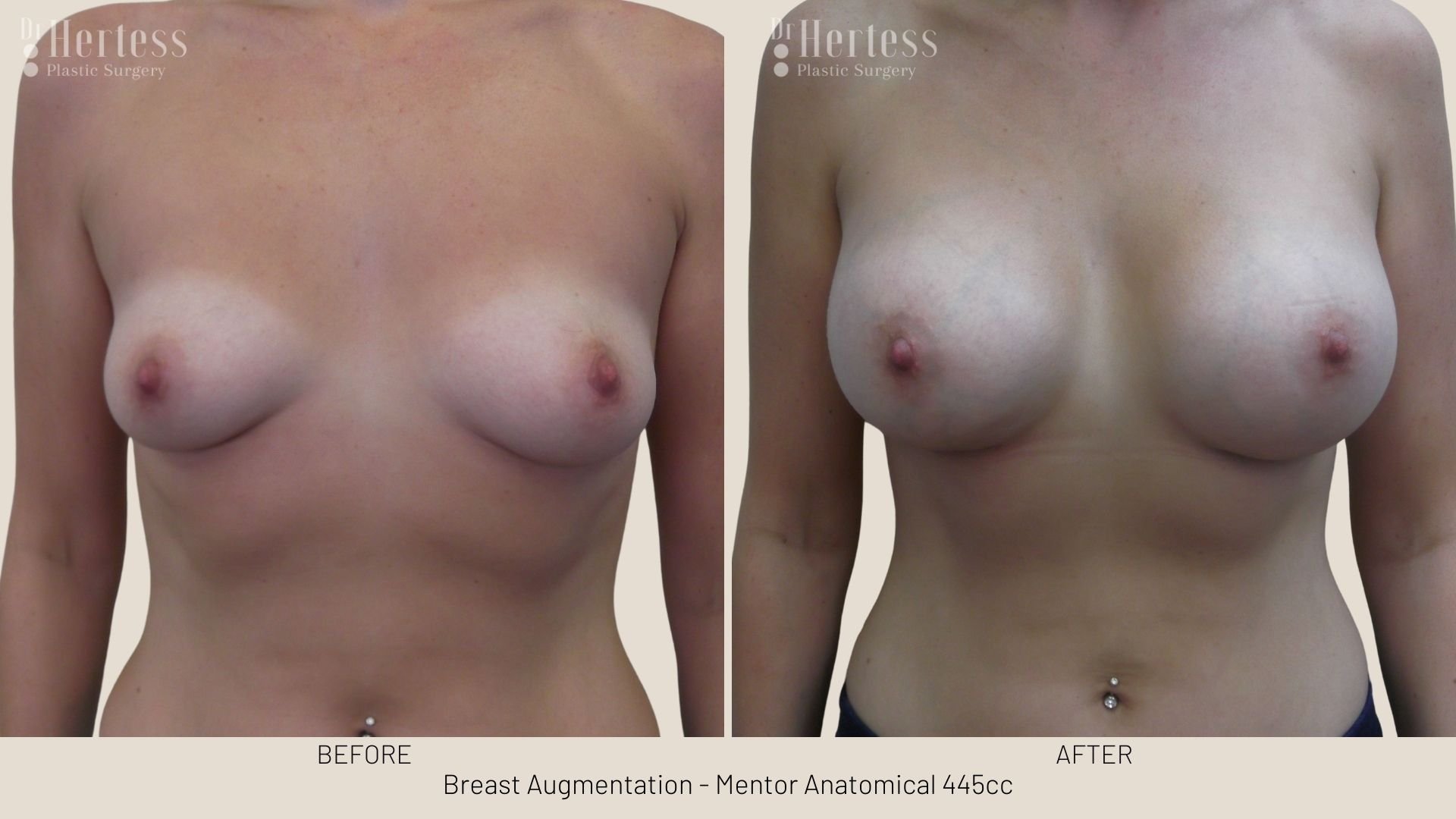 breast aug before and after