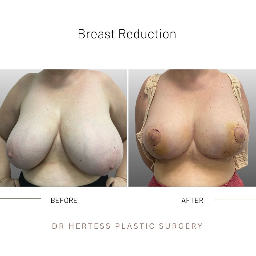 before and after breast reduction