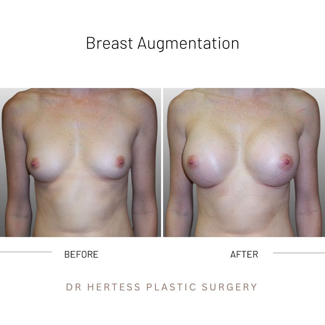 breast enhancement