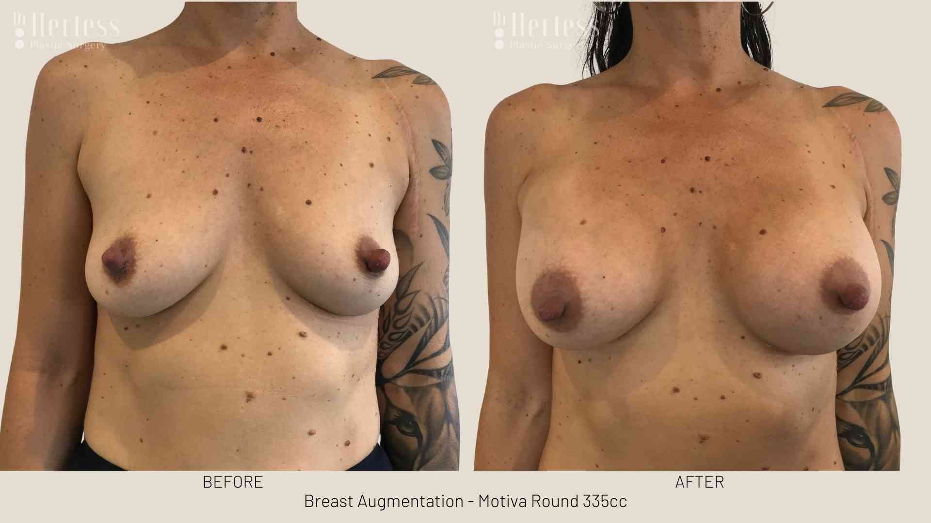 breast implant photos