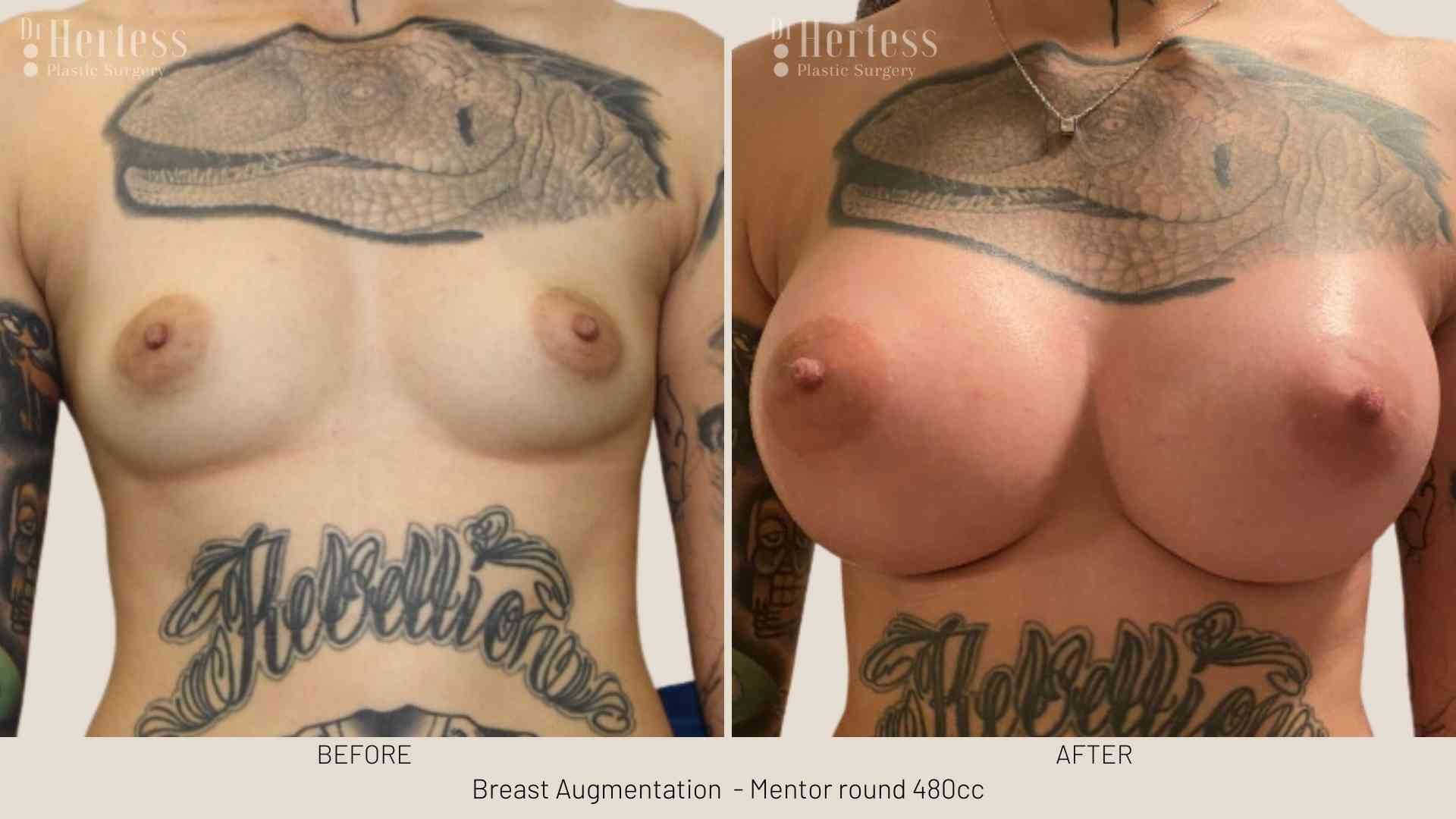 breast job before and after