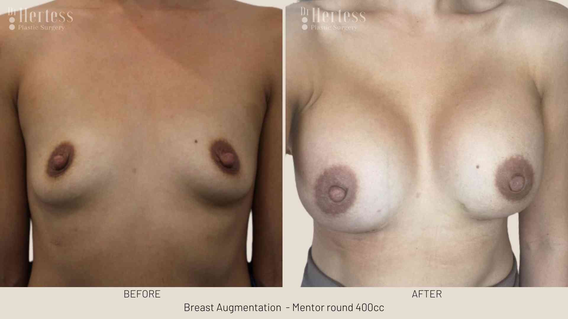 breast job before and after
