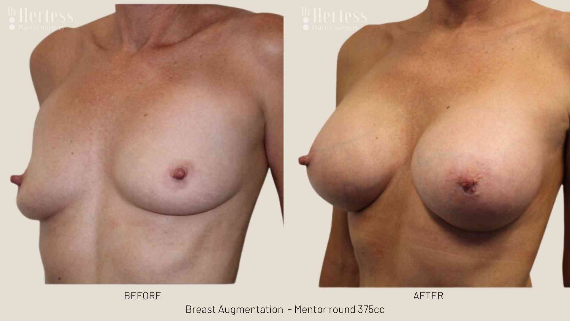 breast job before and after