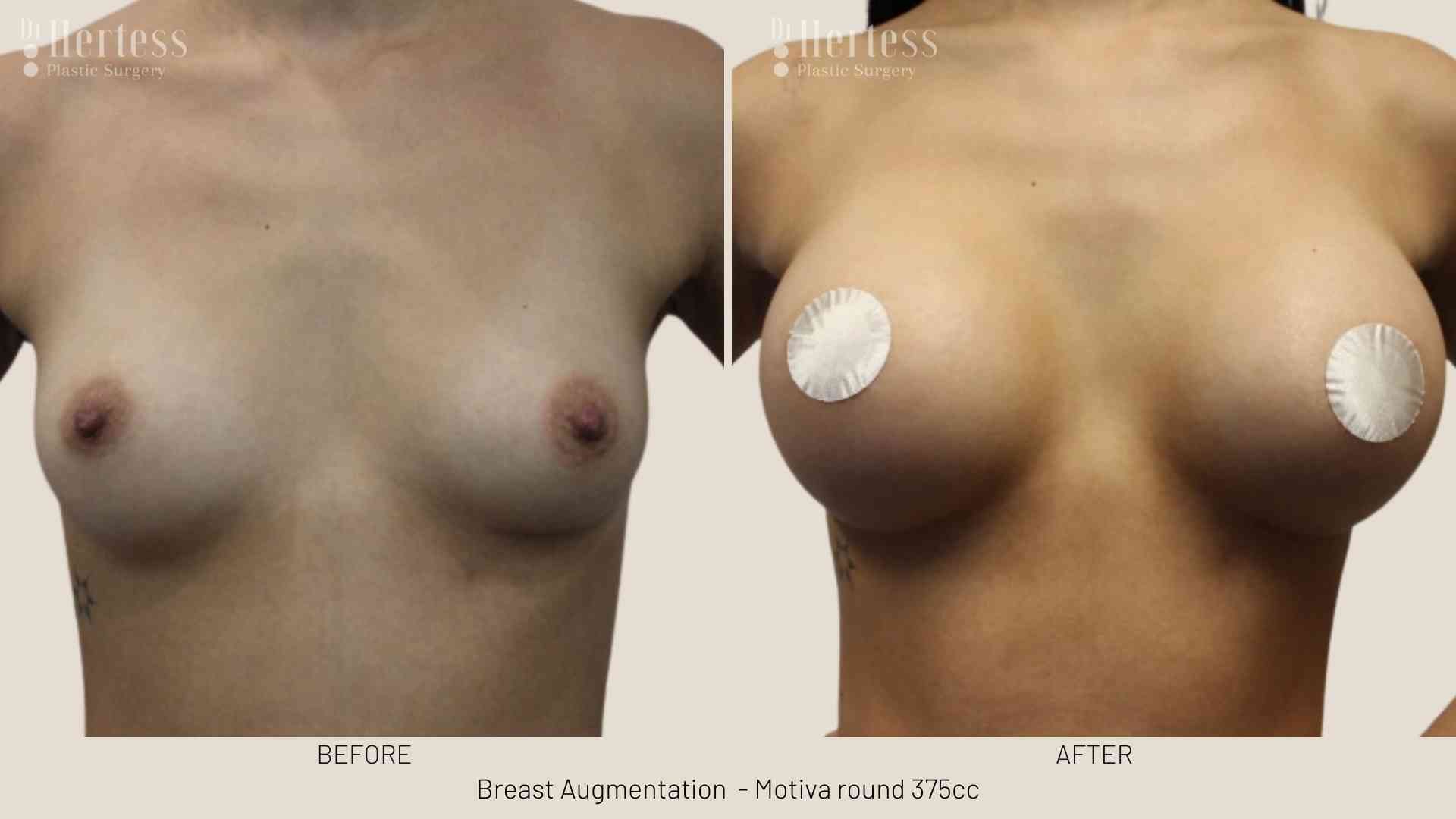 before and after augmentation