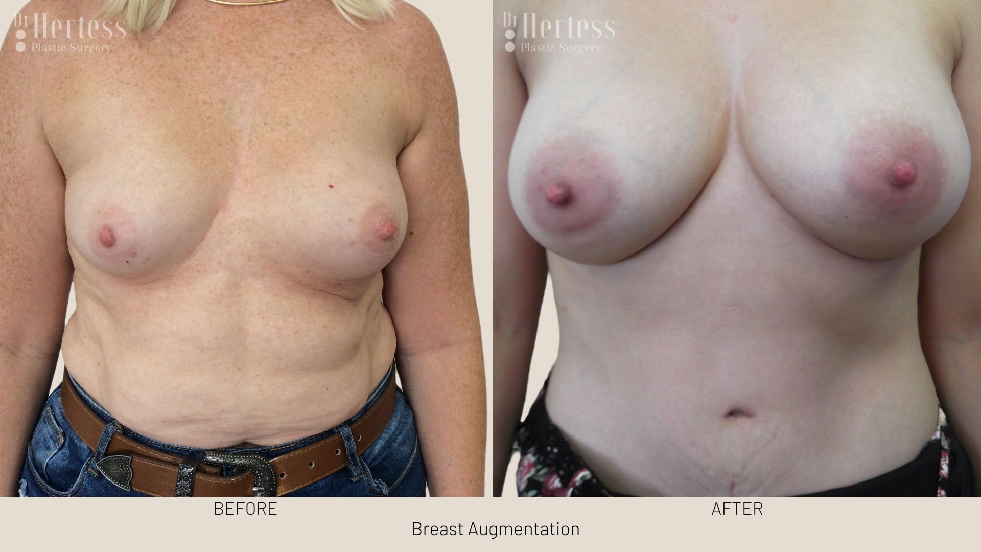 breast enlargement before and after