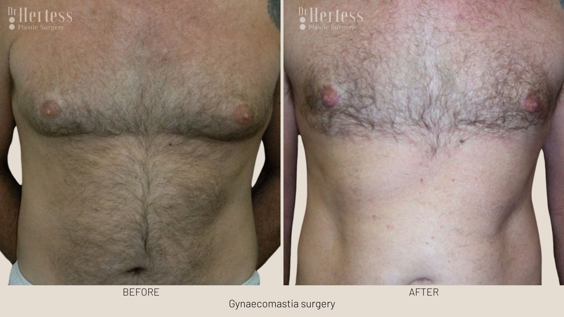 gynecomastia surgery