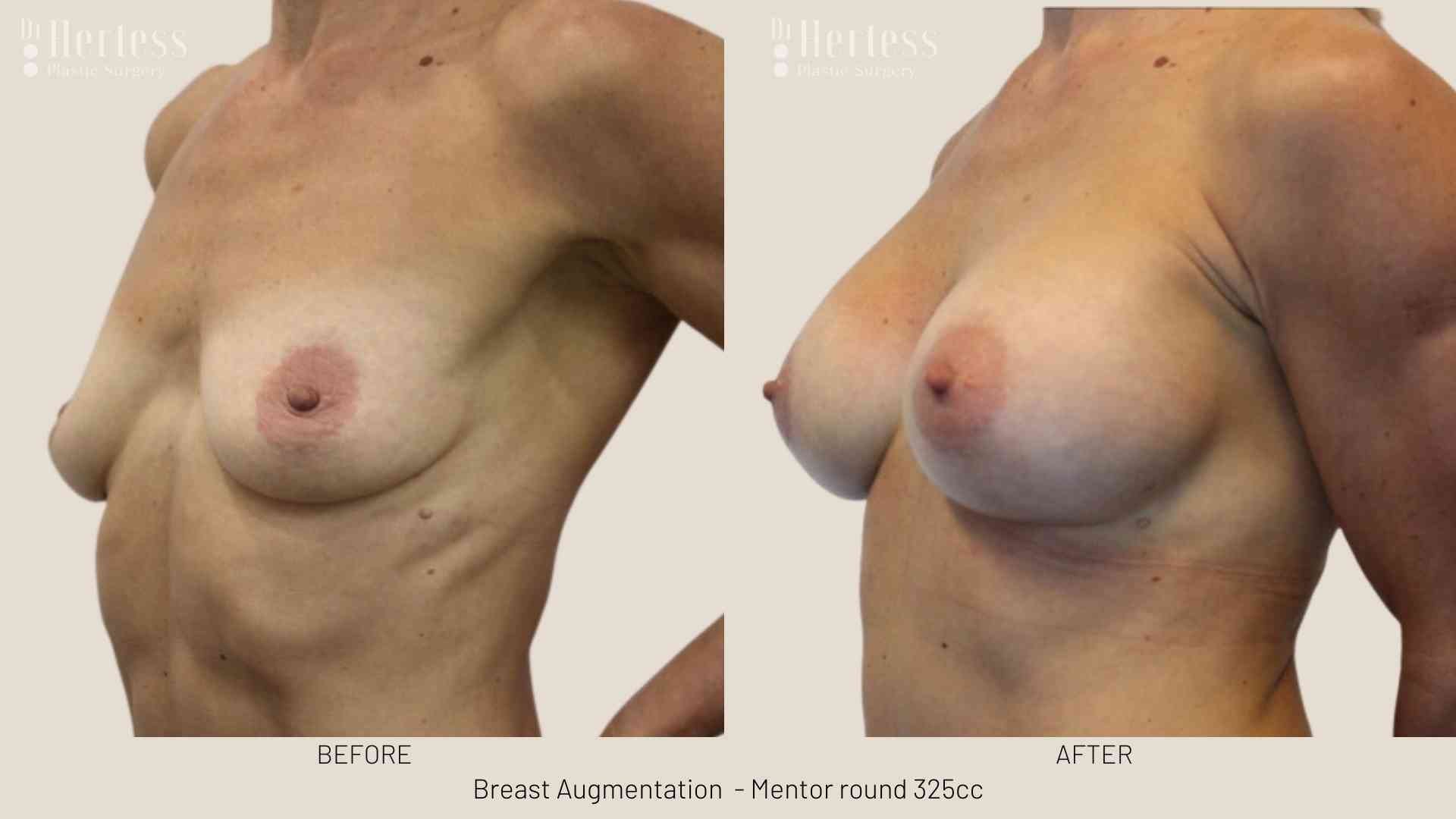 before and after augmentation